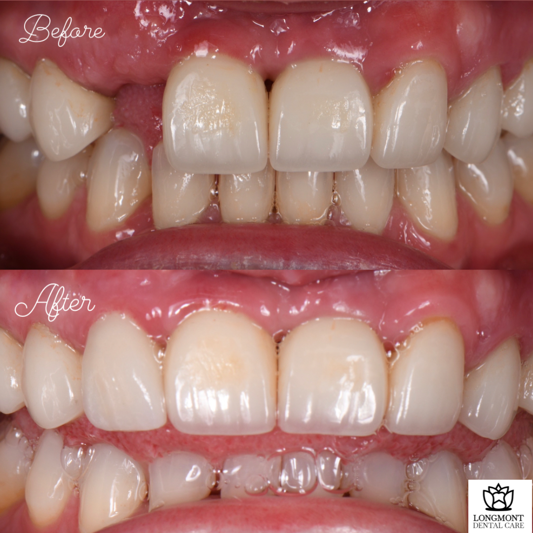 Before and After Smile of Dental Implant Patient | Best Dentist Longmont CO