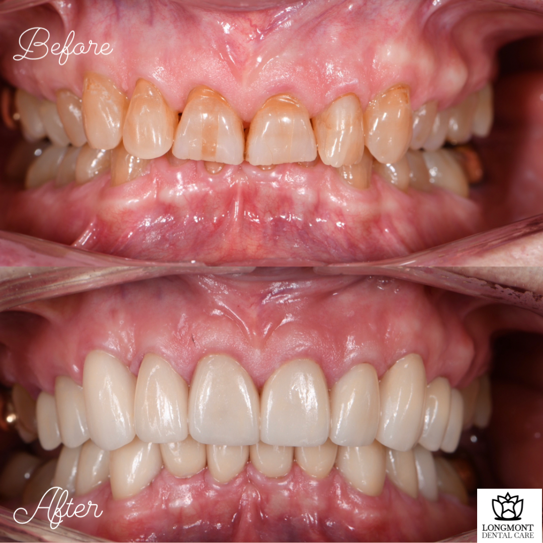 Before and After of Veneers and Dental Crowns | Longmont Dentist Smile Makeover