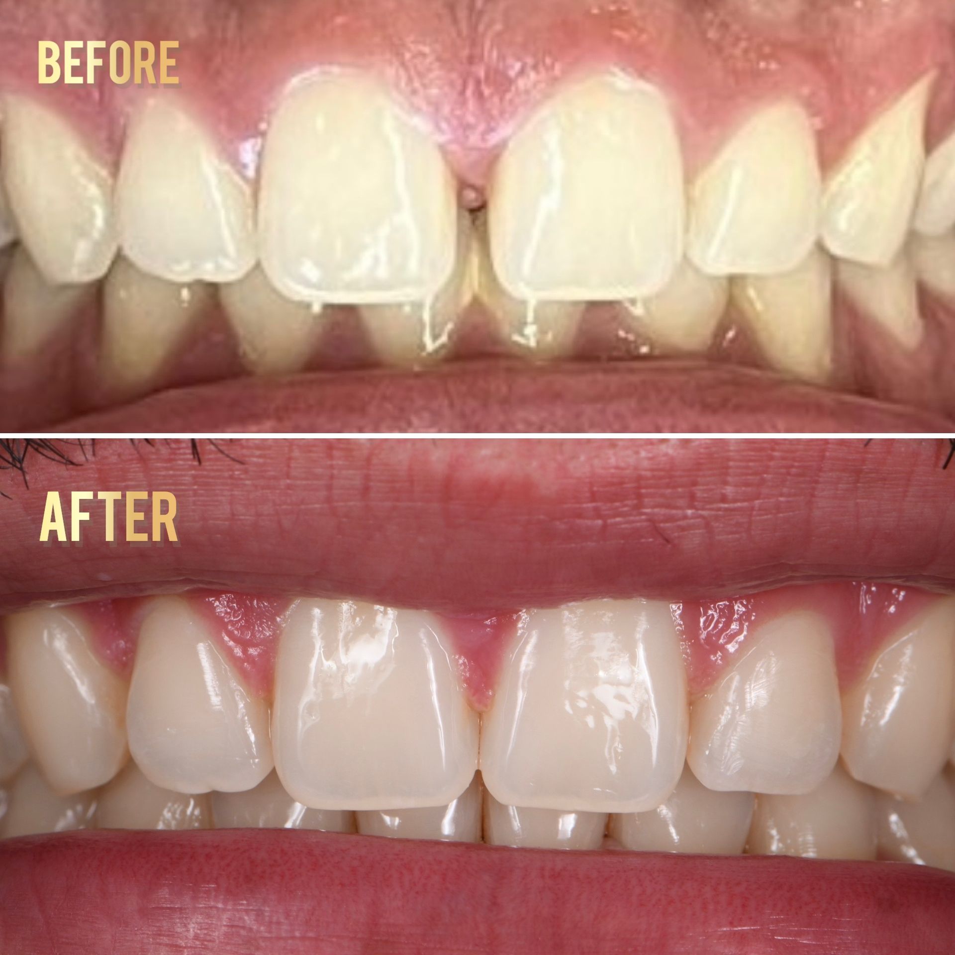 Before and After of Veneers and Dental Crowns | Longmont Dentist Smile Makeover