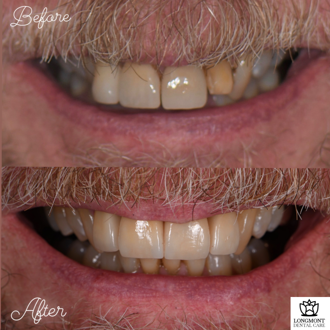 Before and After of Veneers and Dental Crowns | Longmont Dentist Smile Makeover