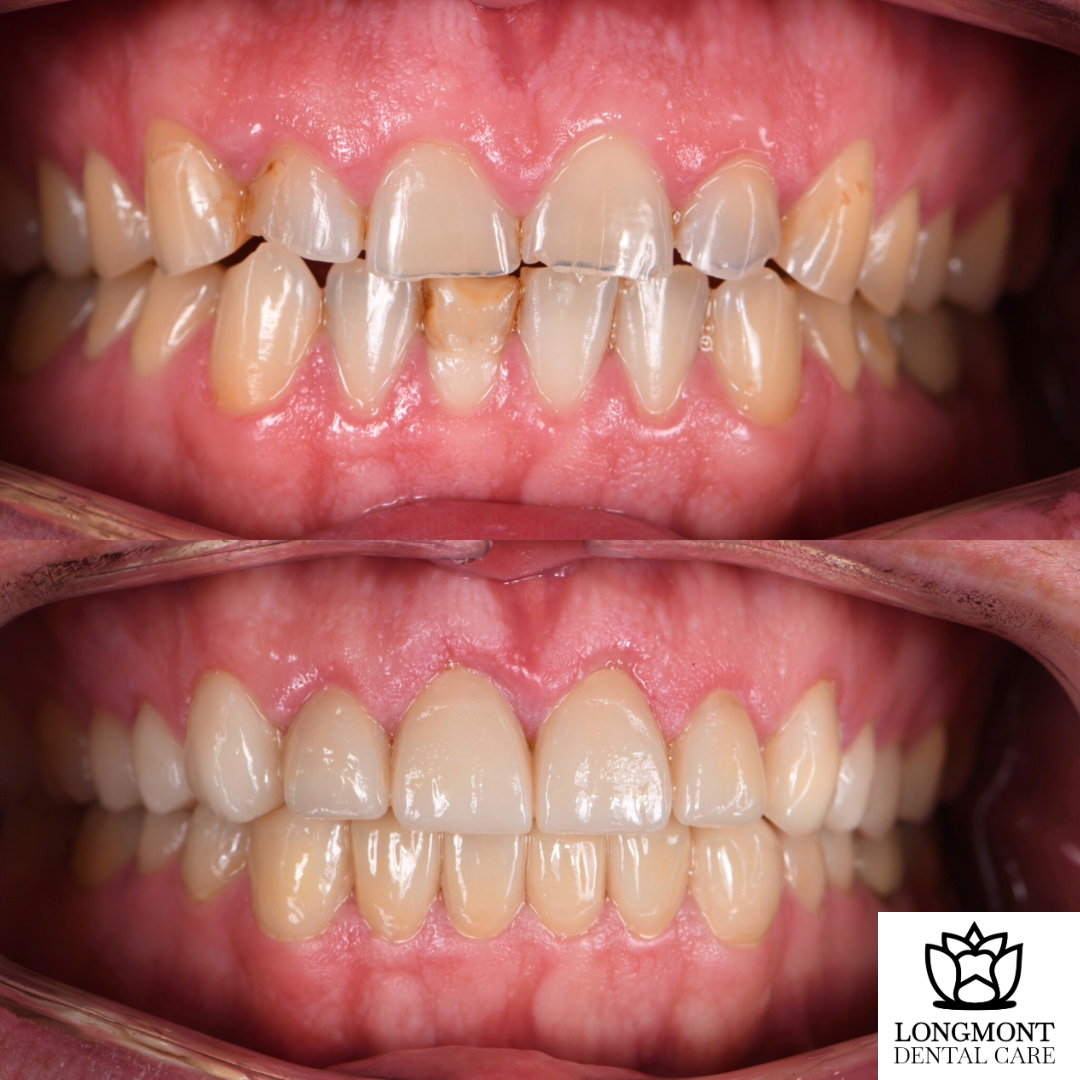 Before and After of Veneers and Dental Crowns | Longmont Dentist Smile Makeover