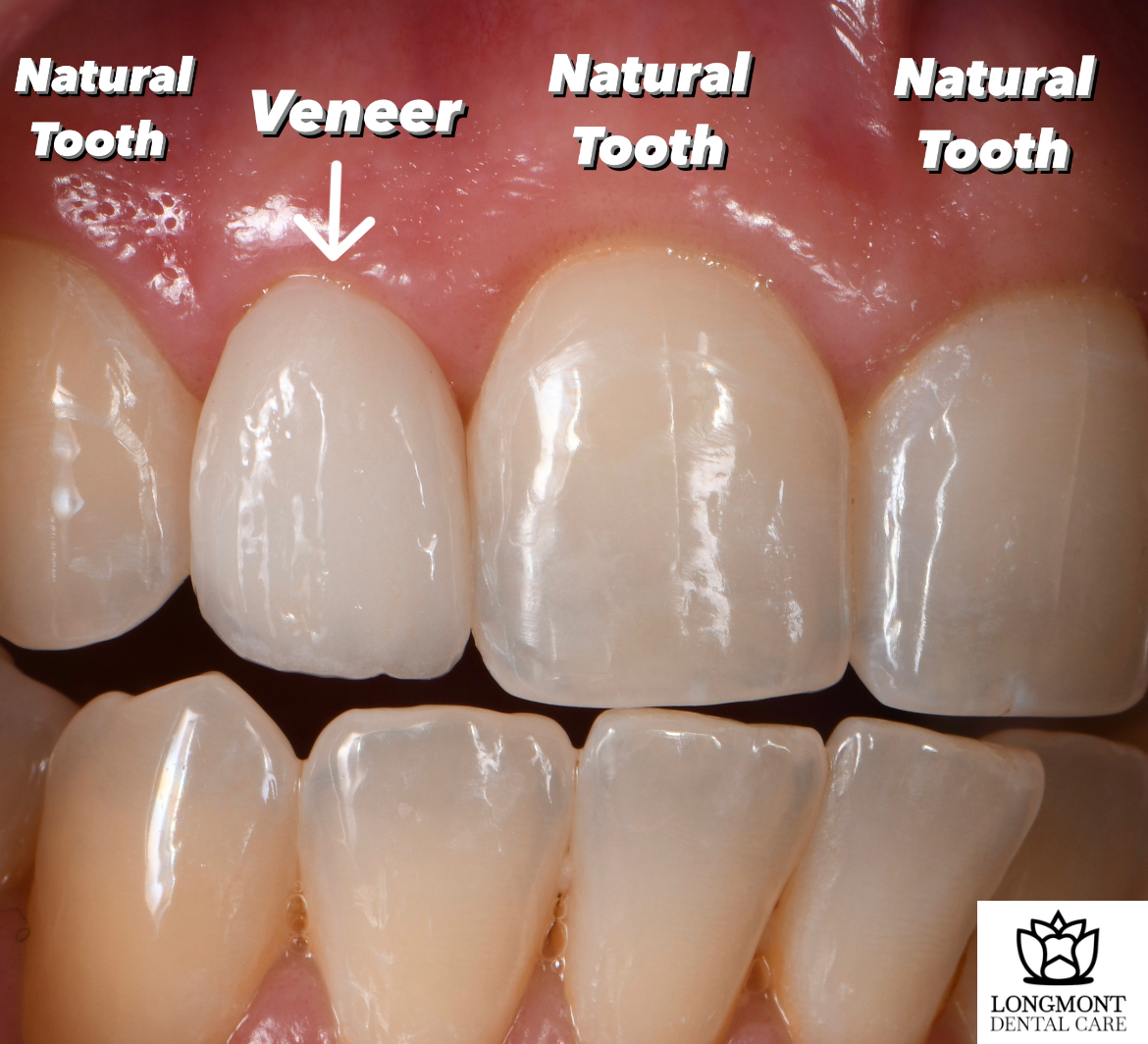 Cosmetic Dental Crowns and Veneers Comparison | Longmont Dentist
