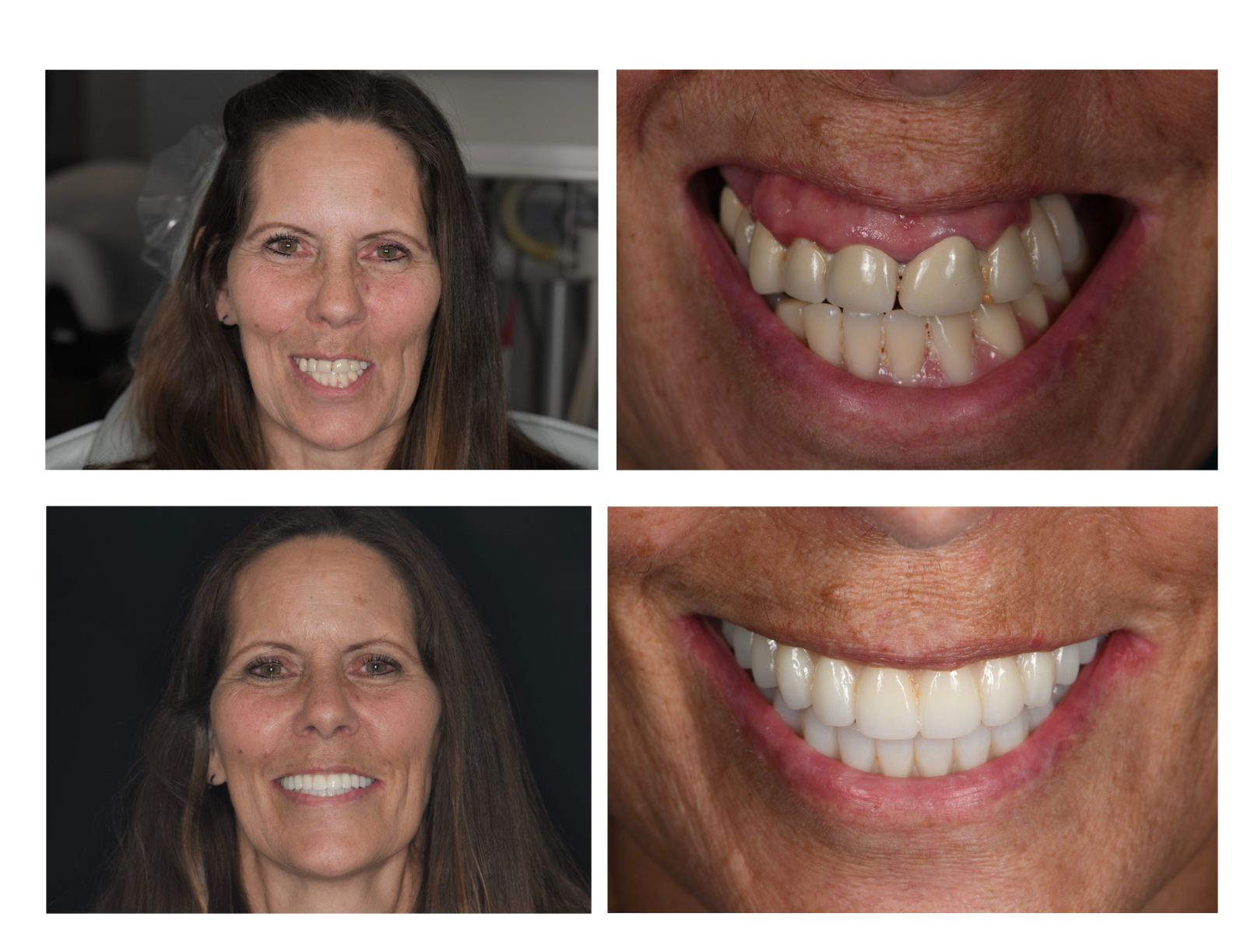Woman's smile before and after dental work: showing improved teeth and facial expression.