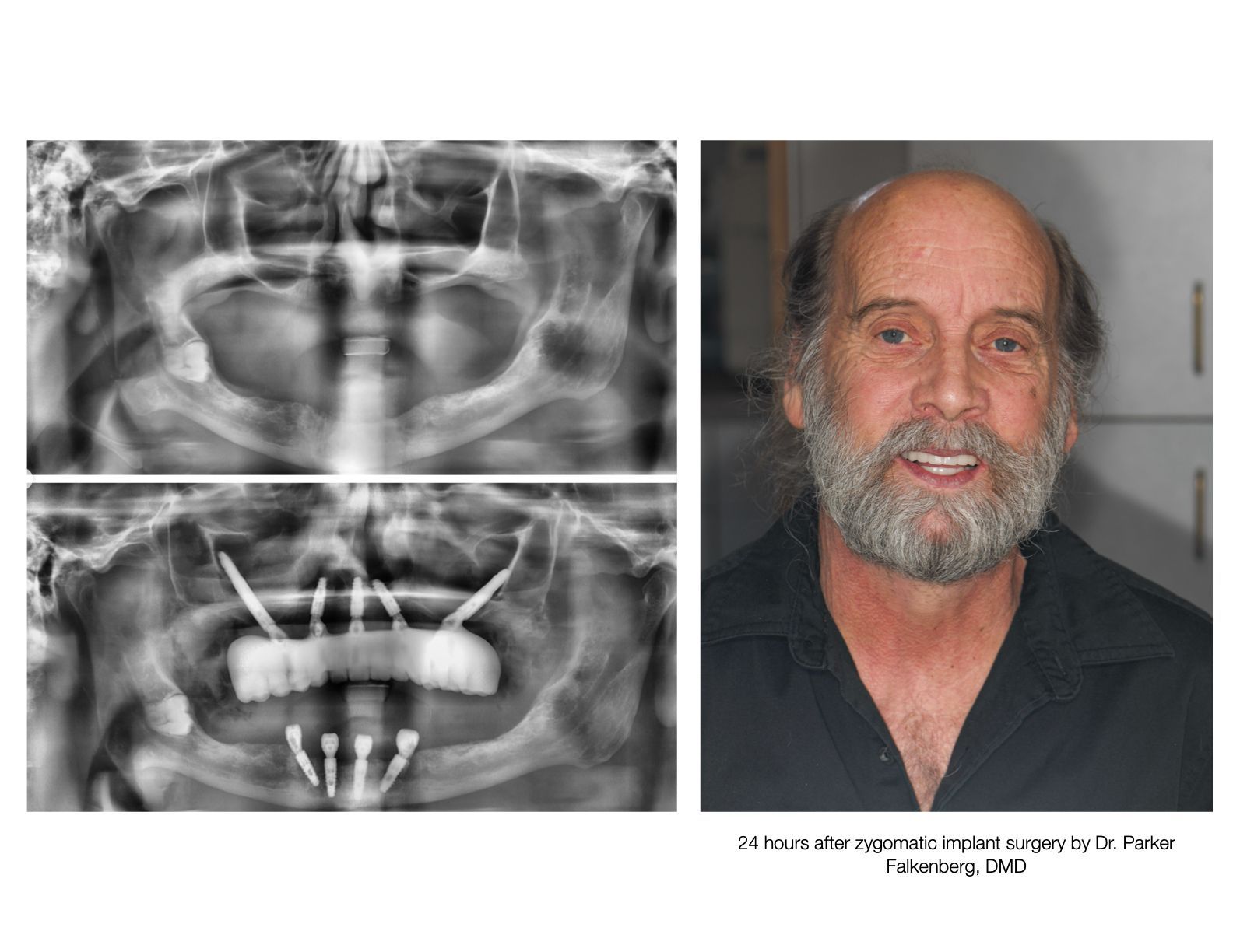 X-rays of a man's jaw, before and after dental implants, next to a smiling man with a beard.