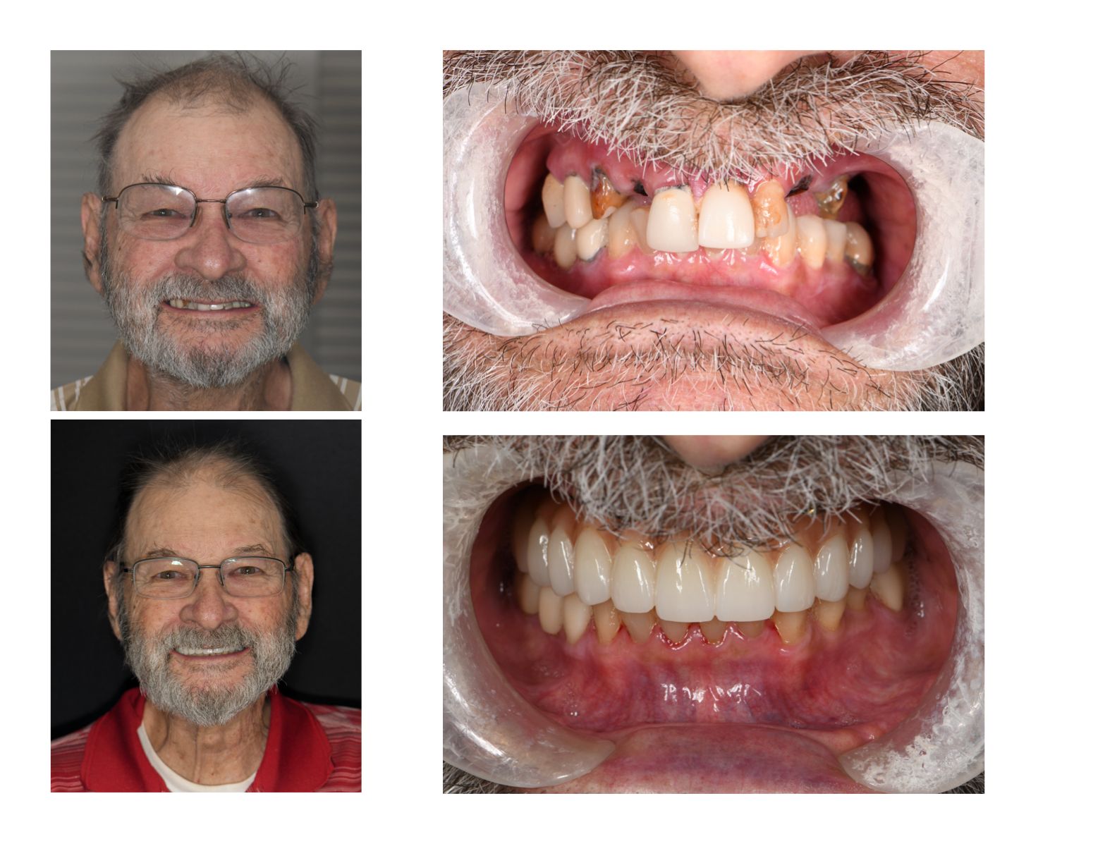 Before-and-after dental work: man with glasses, smiling. Top: damaged teeth. Bottom: new, healthy teeth in red gums.