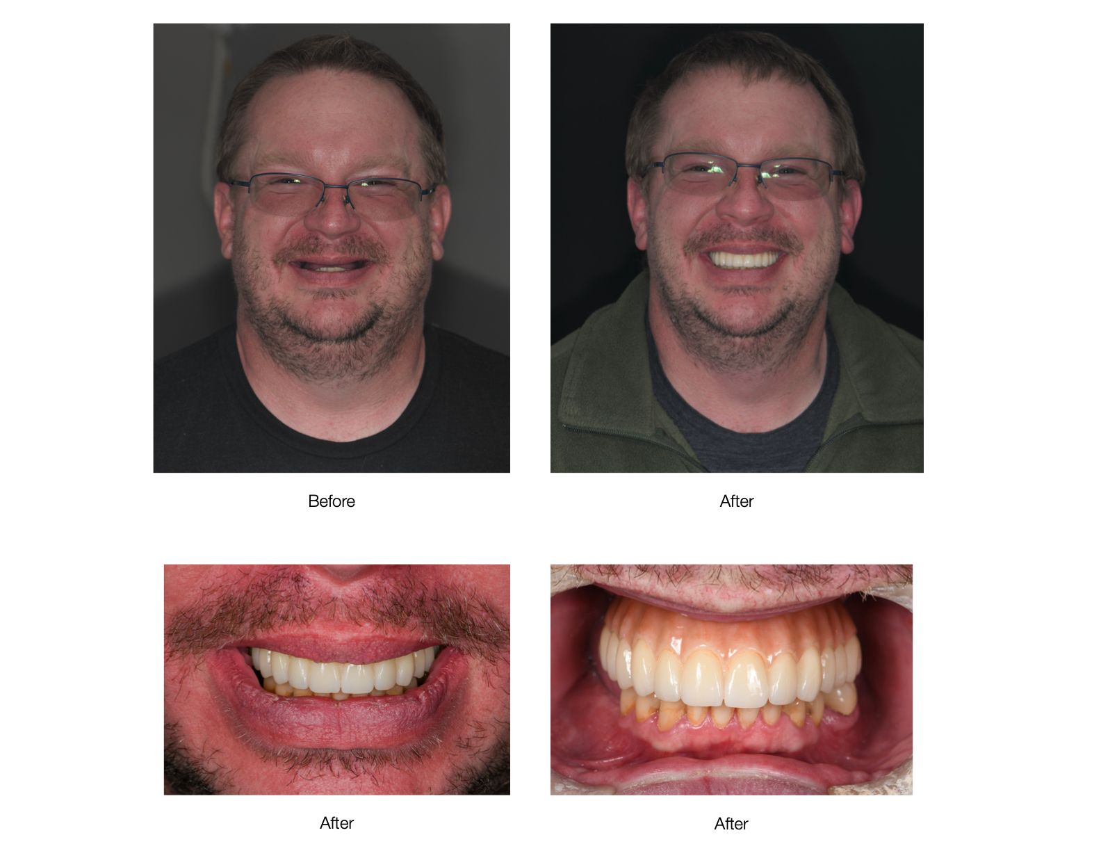 A man with new teeth smiles, comparing before and after shots.
