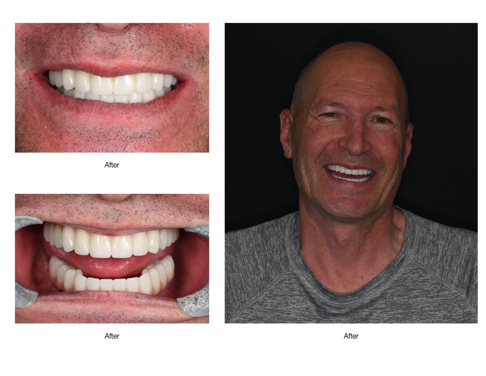 Man smiling, showing off new teeth. Dental work shown with close-up of teeth.