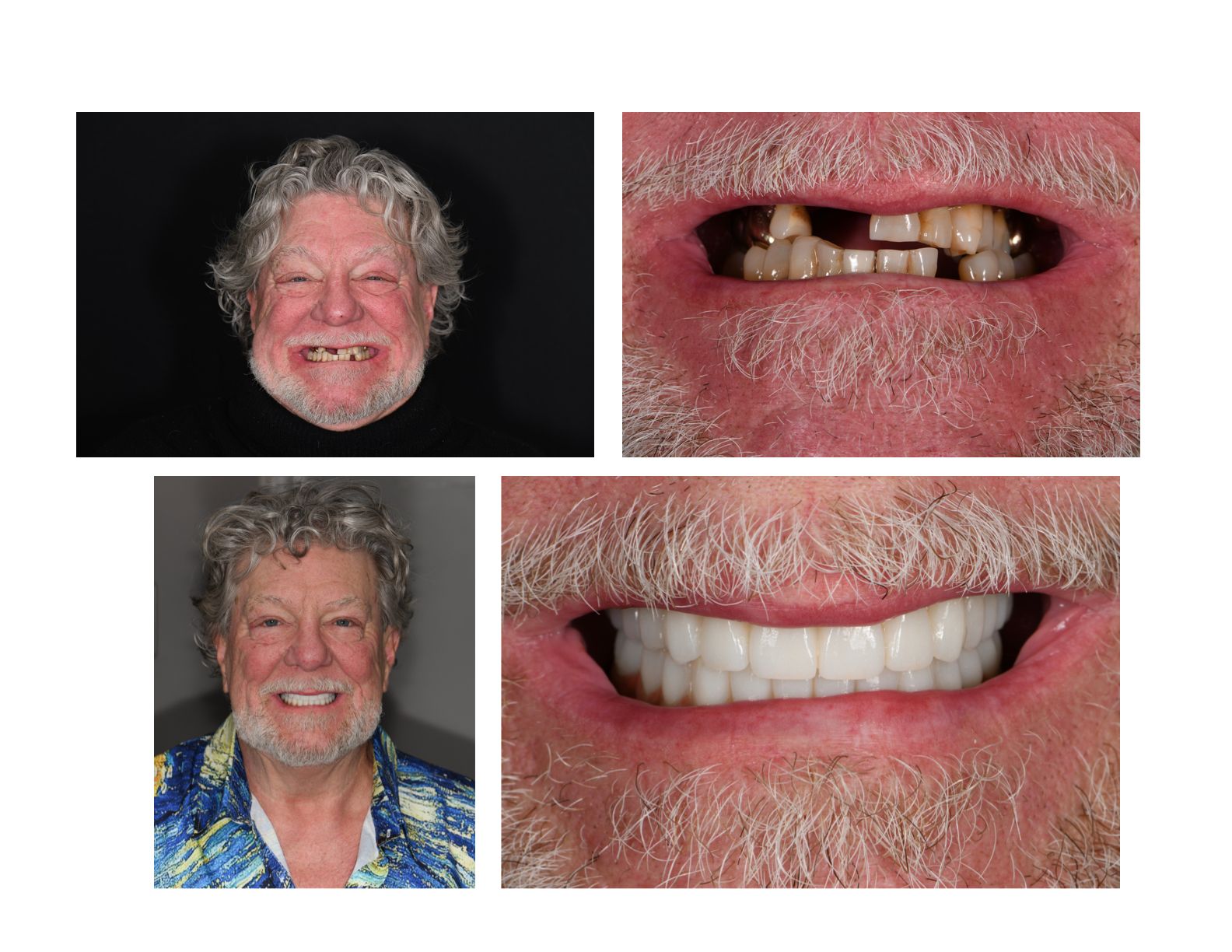 Man with decayed teeth, and after cosmetic dentistry shows a healthy smile.