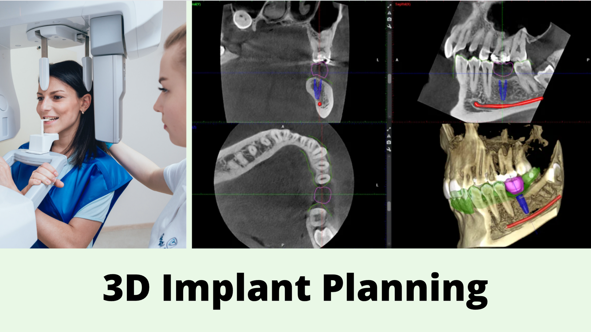 Get dental implants from our family dentist in Longmont, CO A dentist is holding a model of a dental implant.