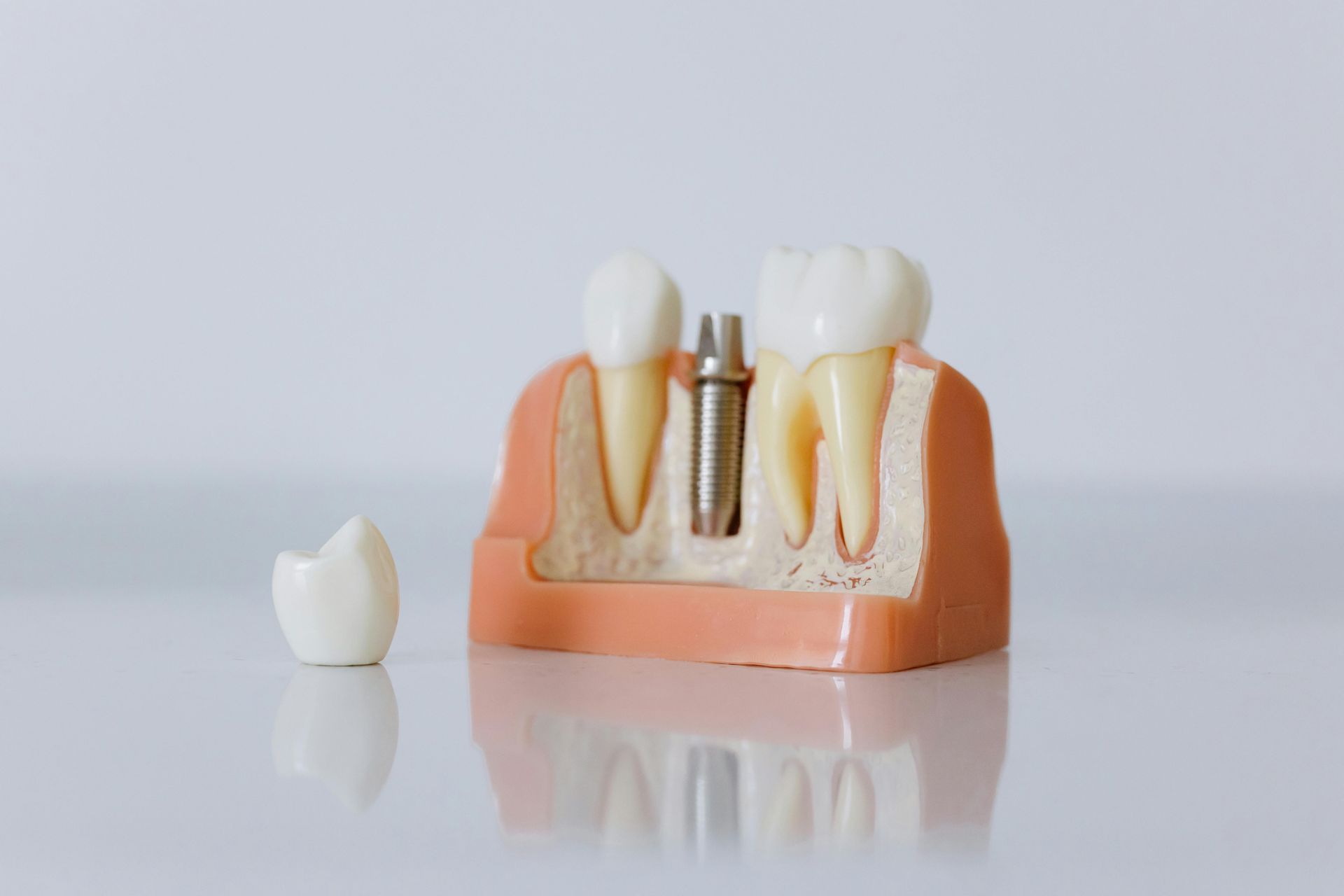 Photo of a model with gums and teeth, showing how a dental implant works and how it is placed