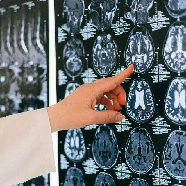 MINIMIZE YOUR RISK OF DEVELOPING DEMENTIA