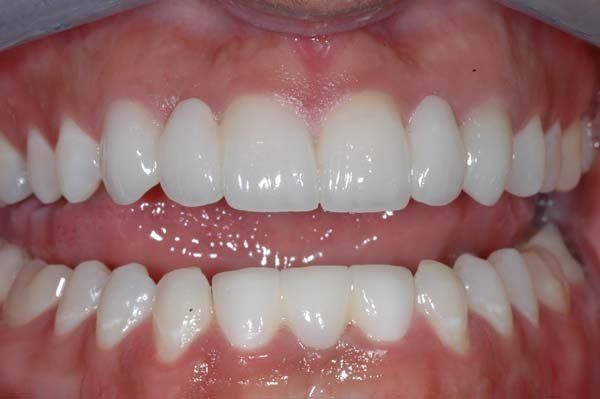 after Procedure: porcelain bridge, gum contouring, and crowns