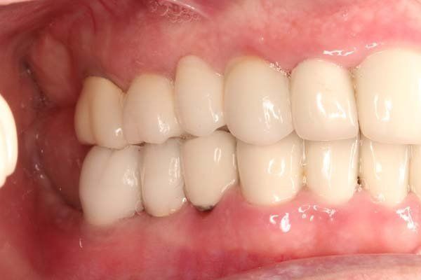 after Procedure: implant crowns