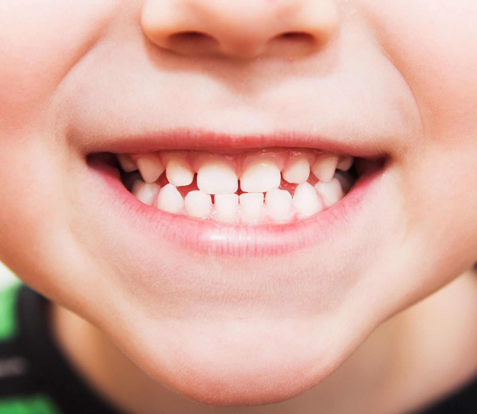 Kiddsmiles  Pediatric Dentistry Treatments- Sedation, Floral Park, white plains, westchester, manhasset, merrick, holbrook, syosset, port jefferson station, north babylon, nassau county, suffolk county