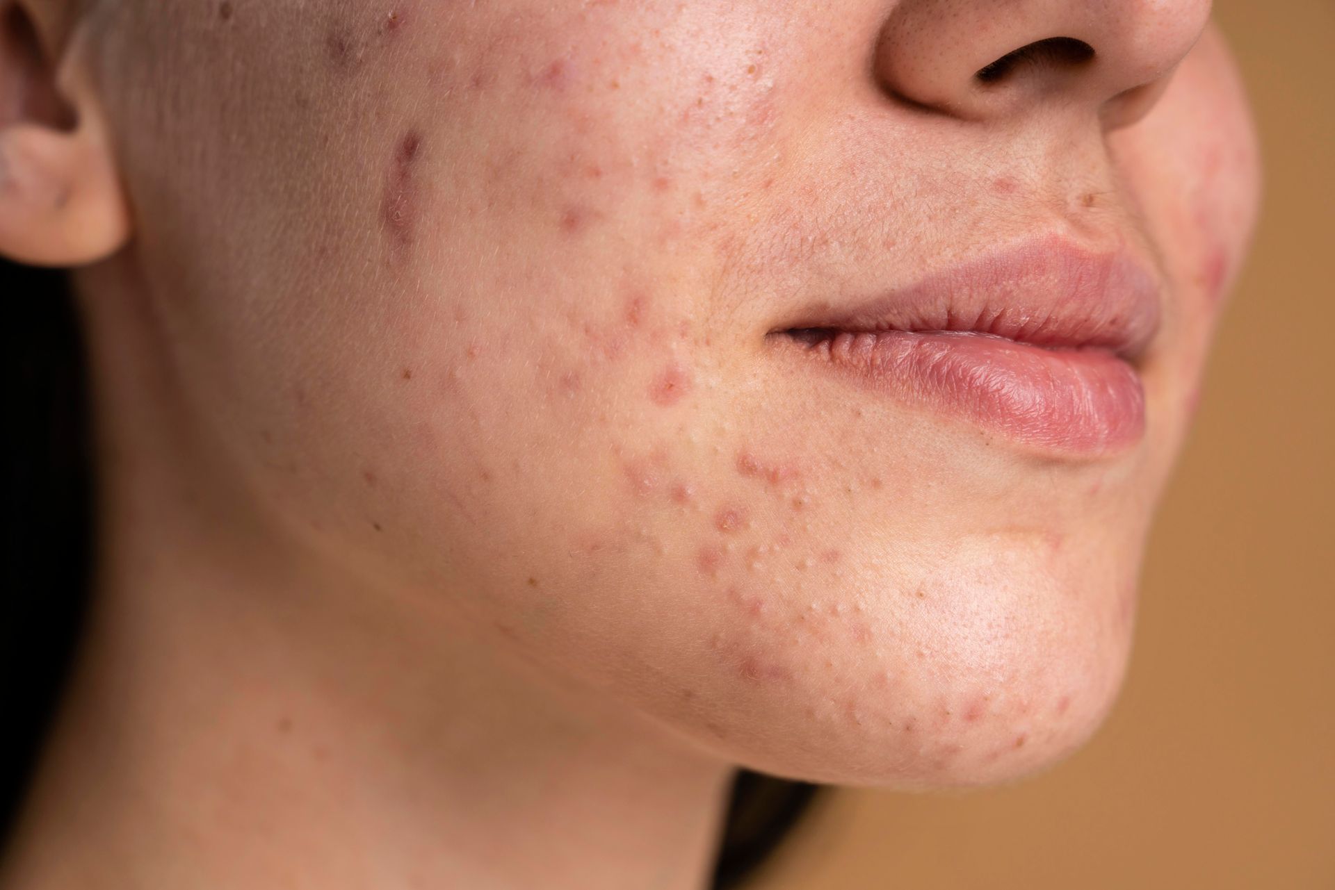 a close up of a woman 's face with acne