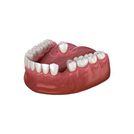 3D model of lower teeth and pink gums with a single upper tooth at the center