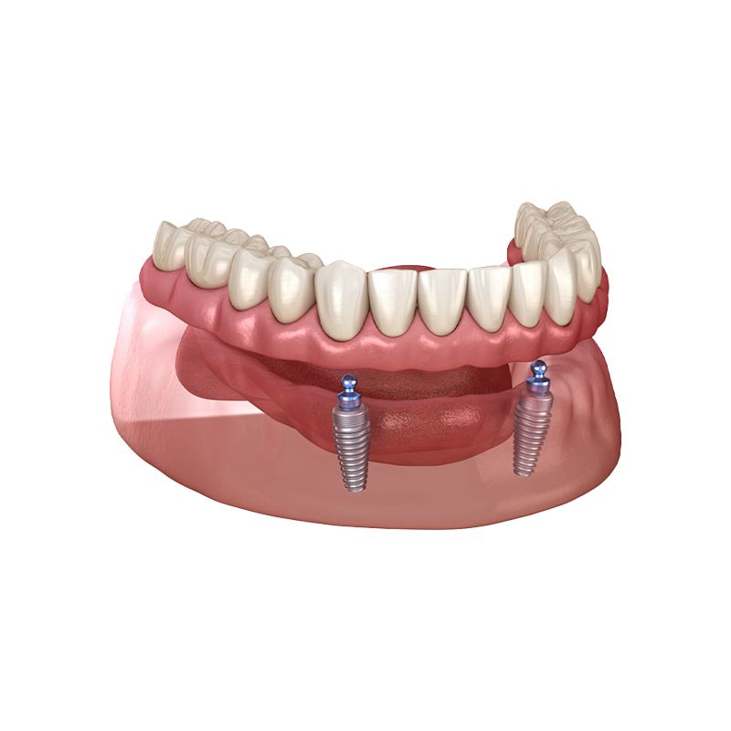 Dental implant model with lower jaw and two blue implant posts supporting teeth