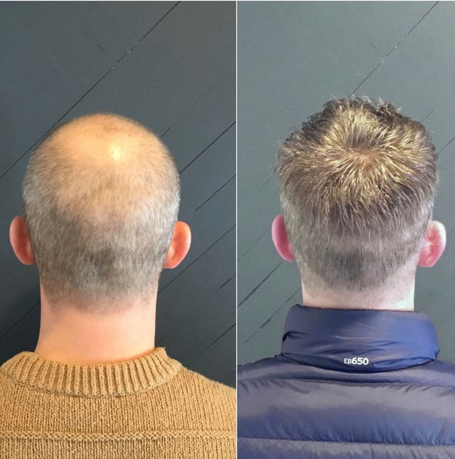 A before and after picture of a man 's head