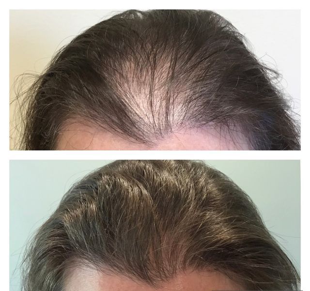 A before and after photo of a woman 's hair growth.