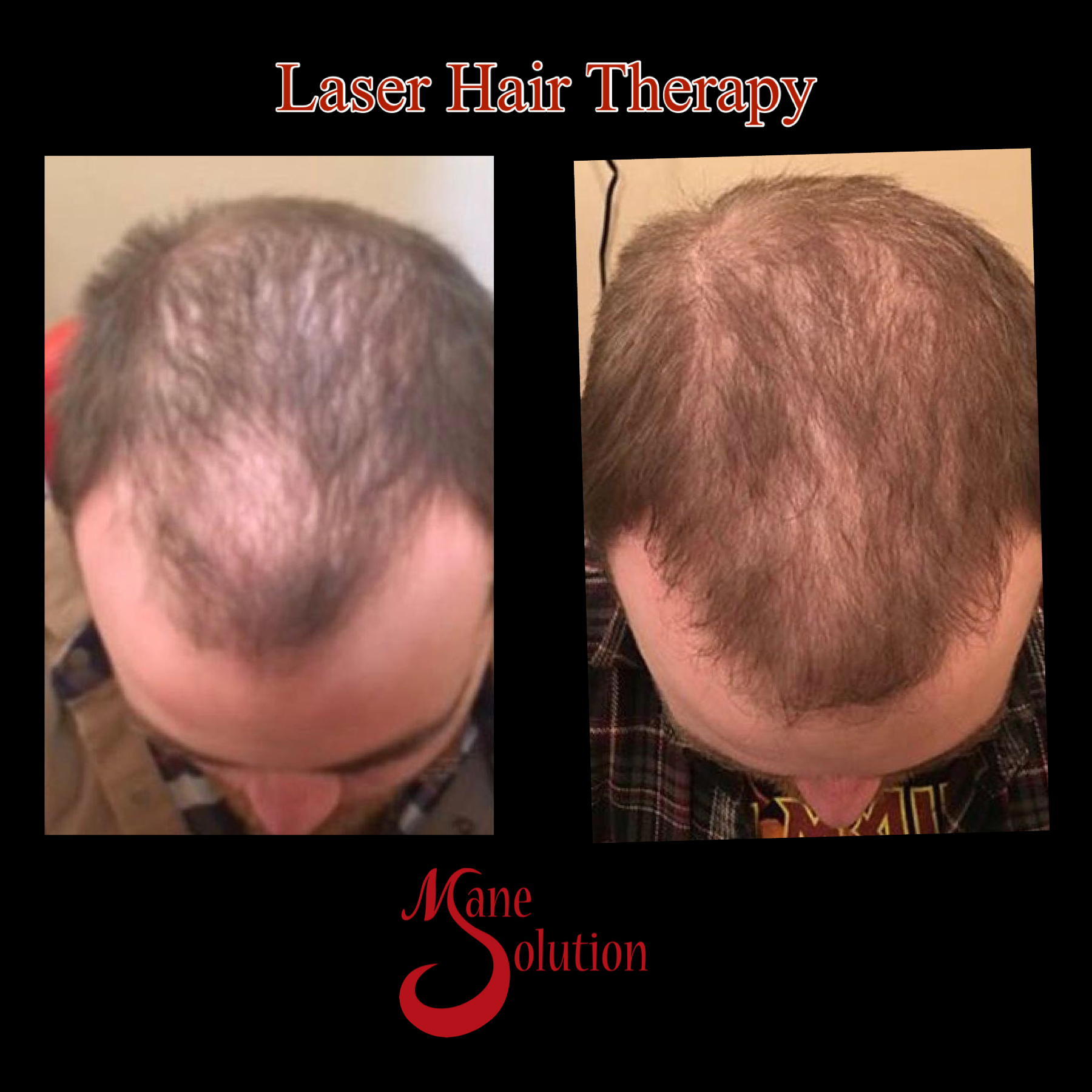 A picture of a man 's hair before and after laser hair therapy