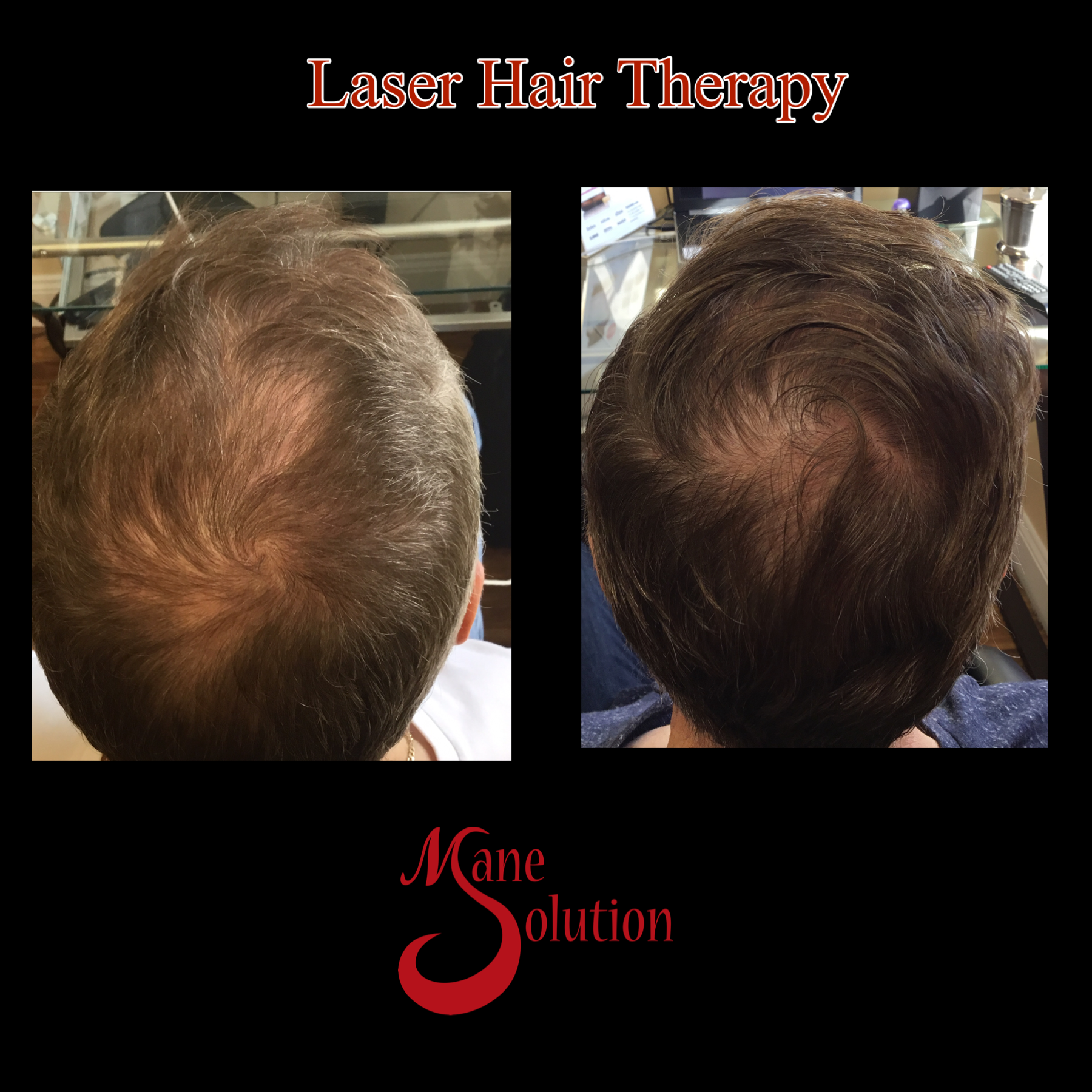 A picture of a man 's hair before and after laser hair therapy