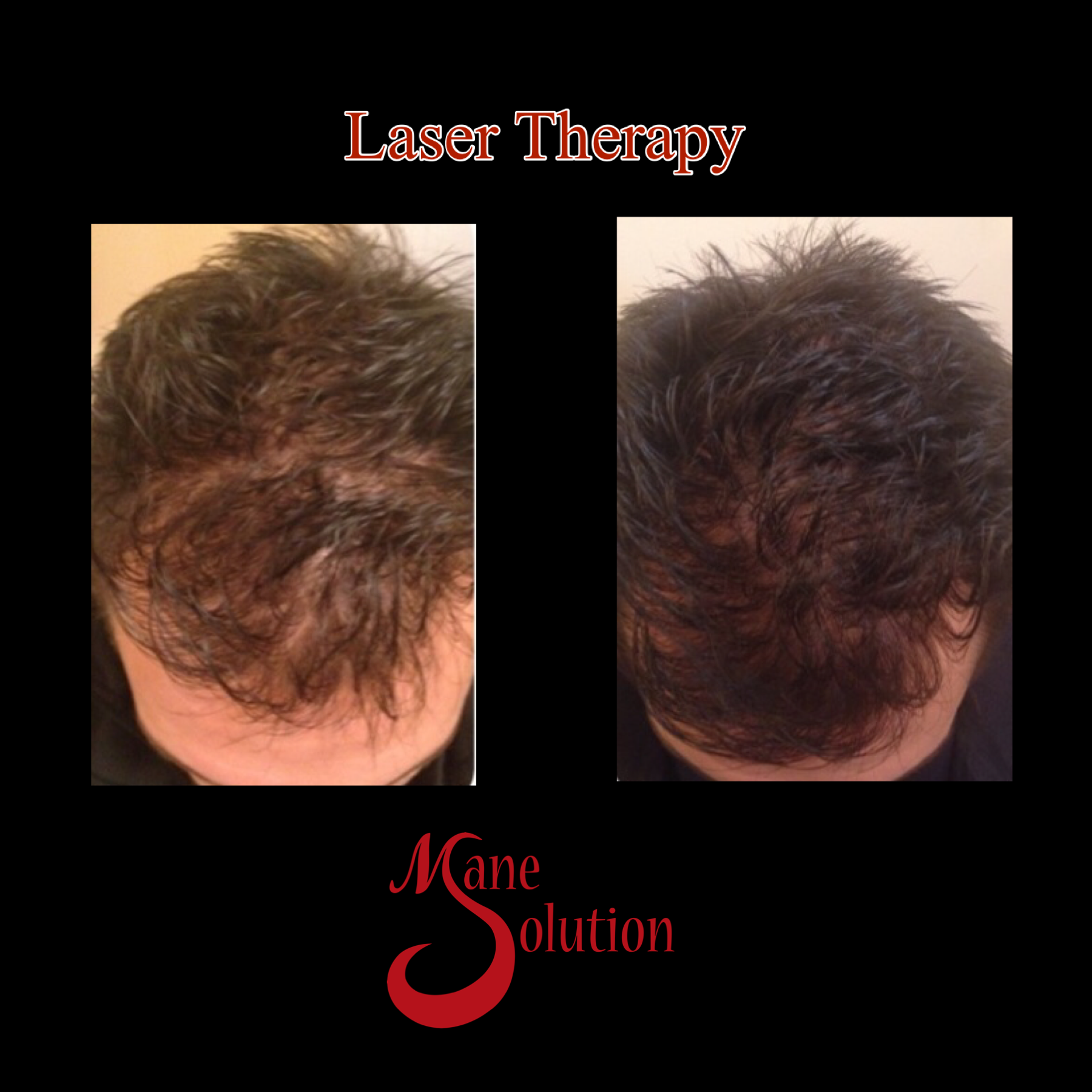 A picture of a man 's hair before and after laser therapy