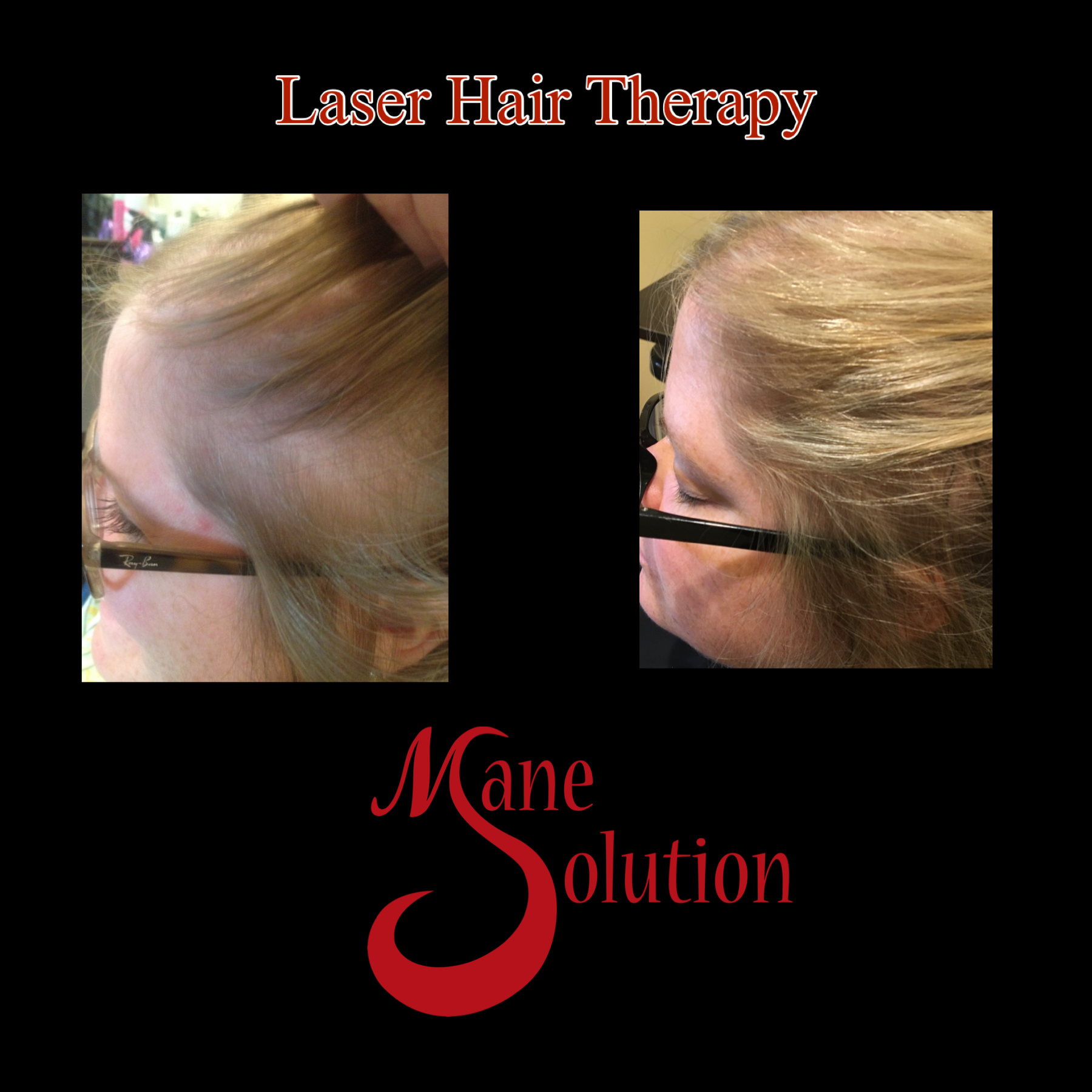 A picture of a woman 's hair before and after laser hair therapy