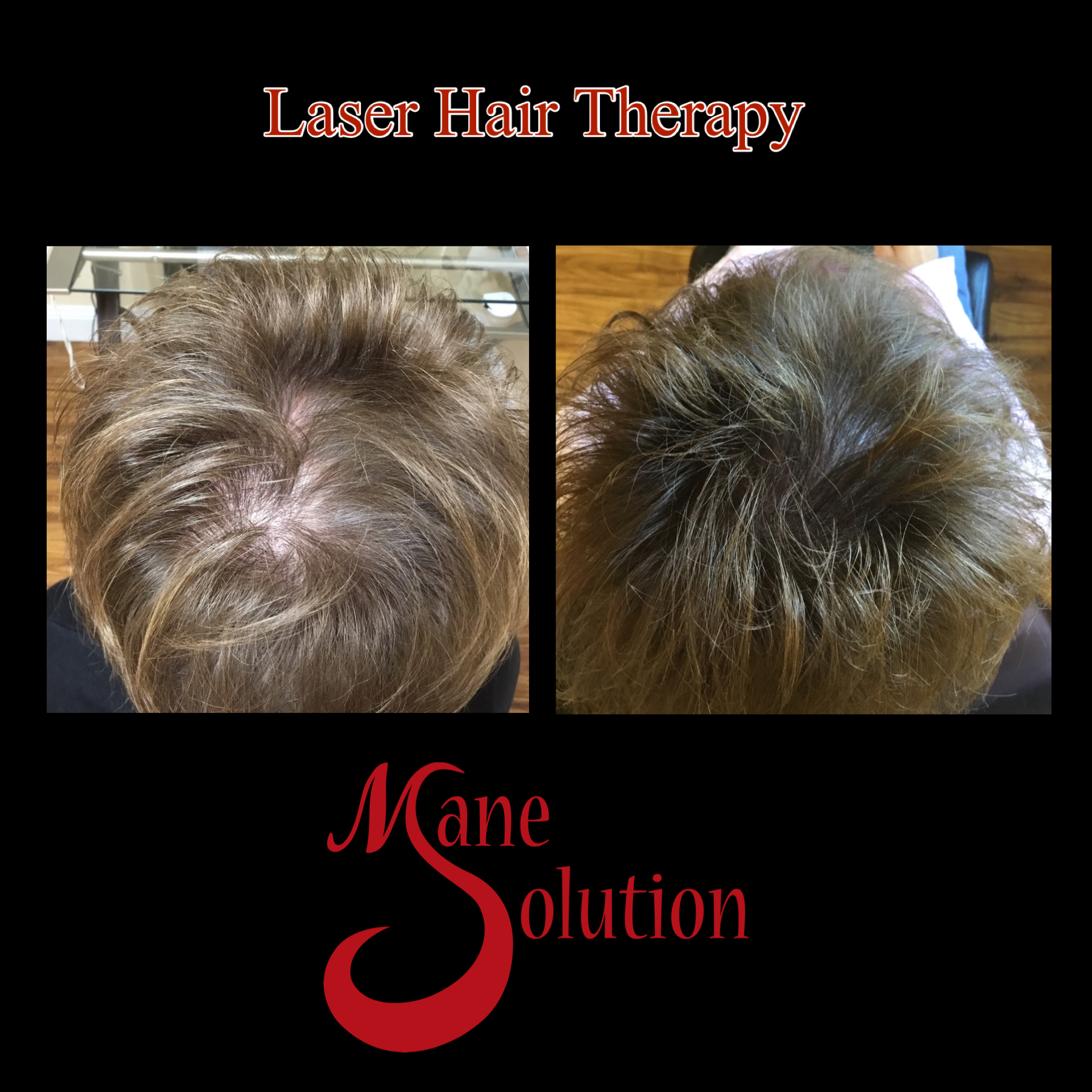 A picture of a man 's hair before and after laser hair therapy