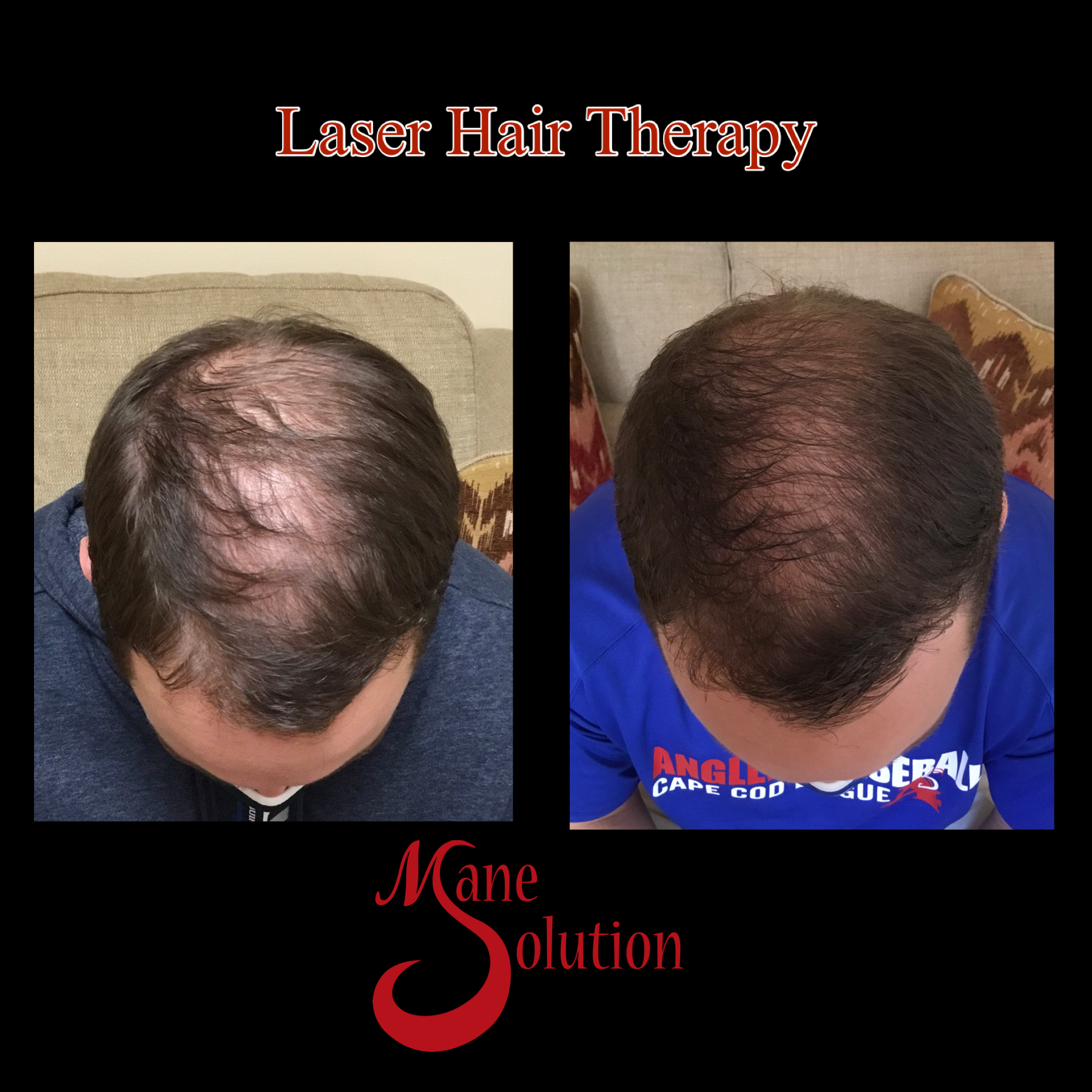 A picture of a man 's hair before and after laser hair therapy
