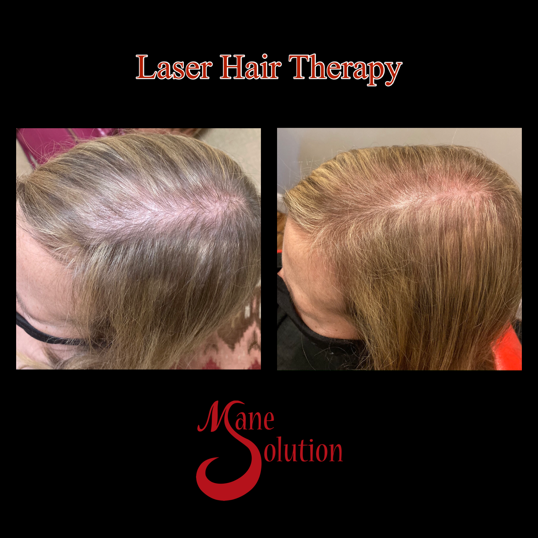 A picture of a woman 's hair before and after laser hair therapy