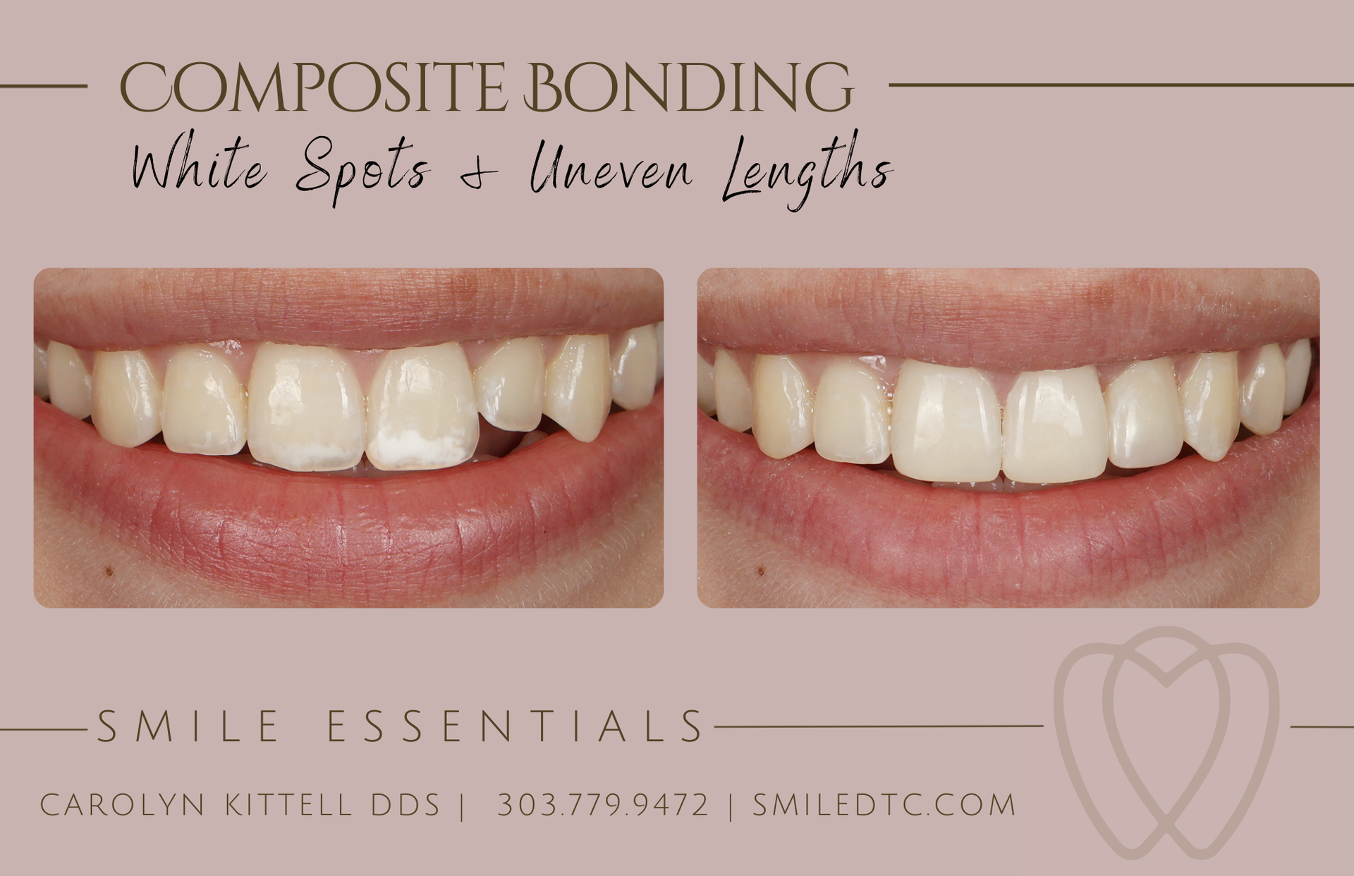 white spot treated with composite bonding