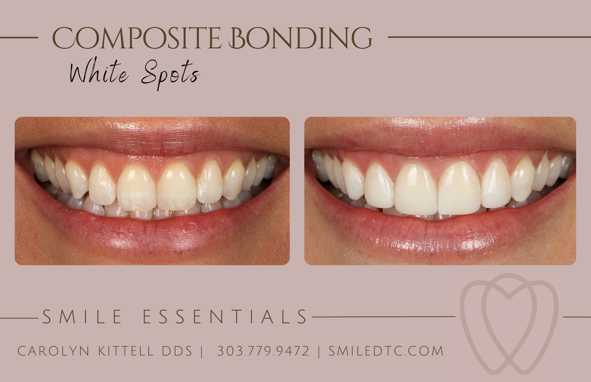 white spots on teeth