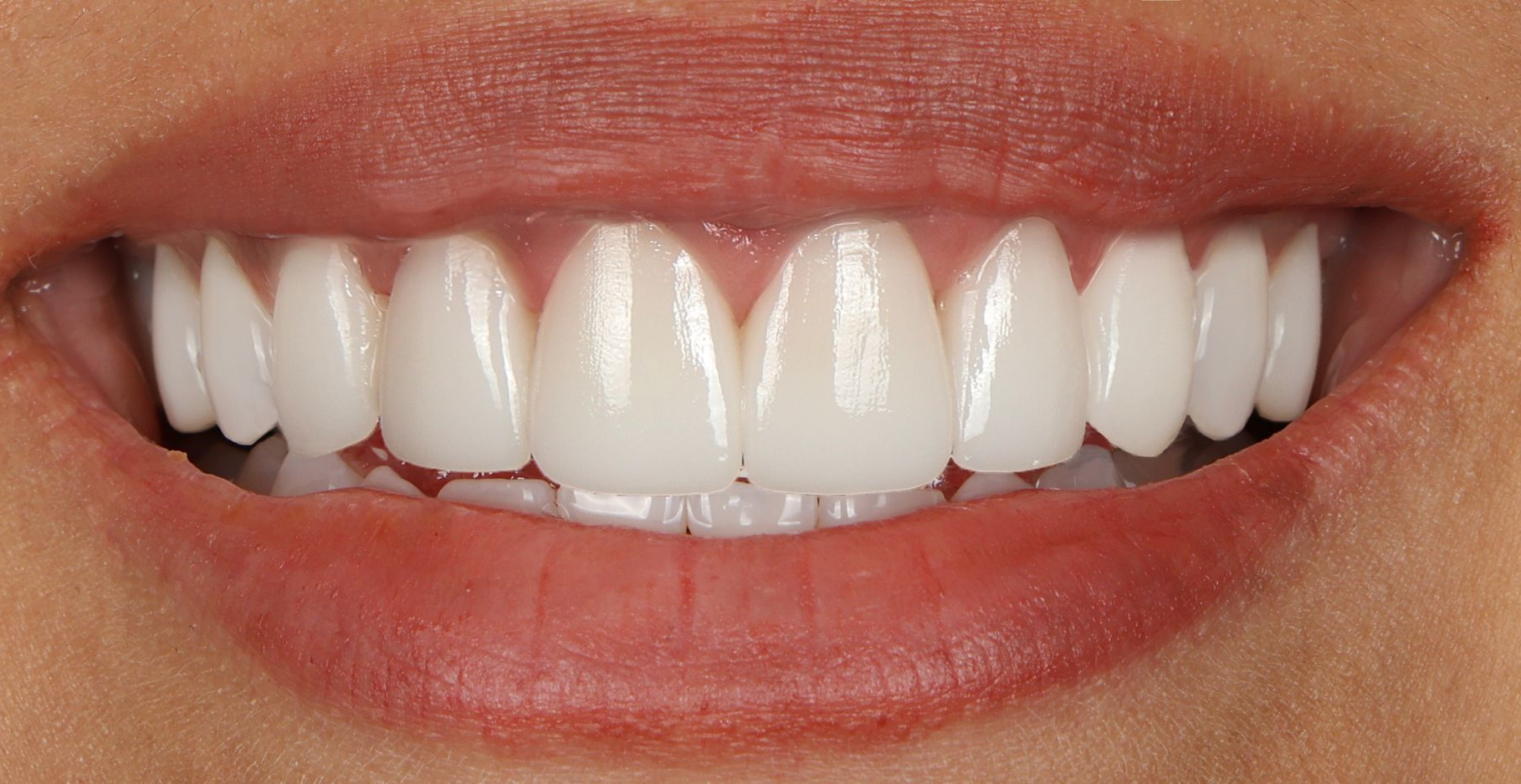 veneers
