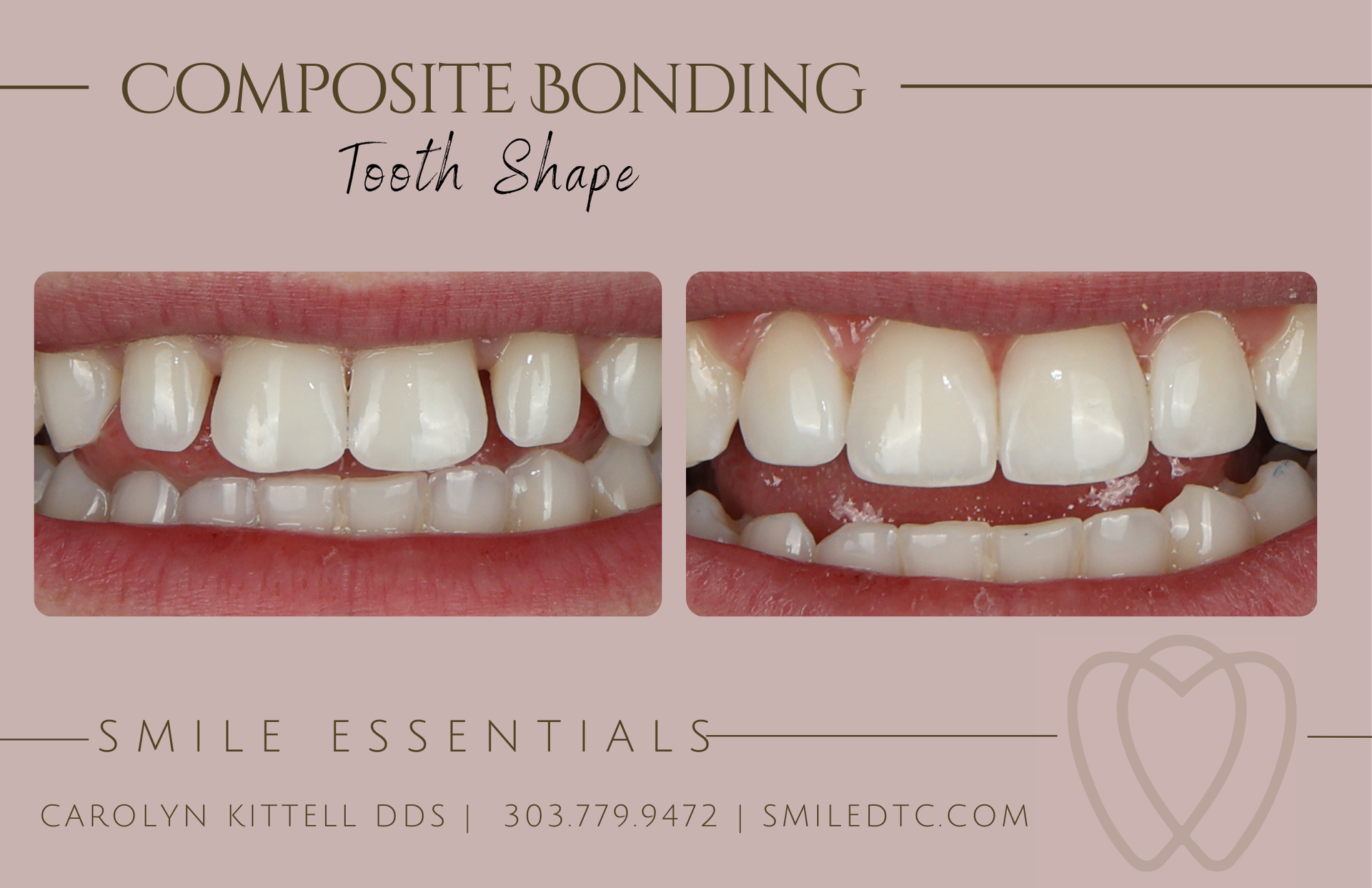 Composite bonding is shown on a pink background