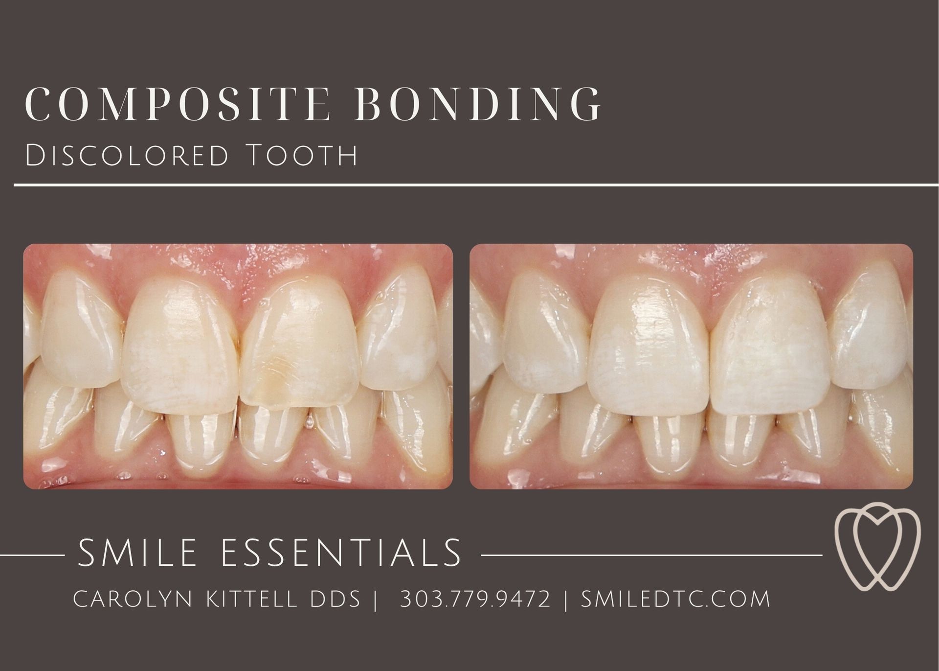 discolored teeth, fluorosis, white spots