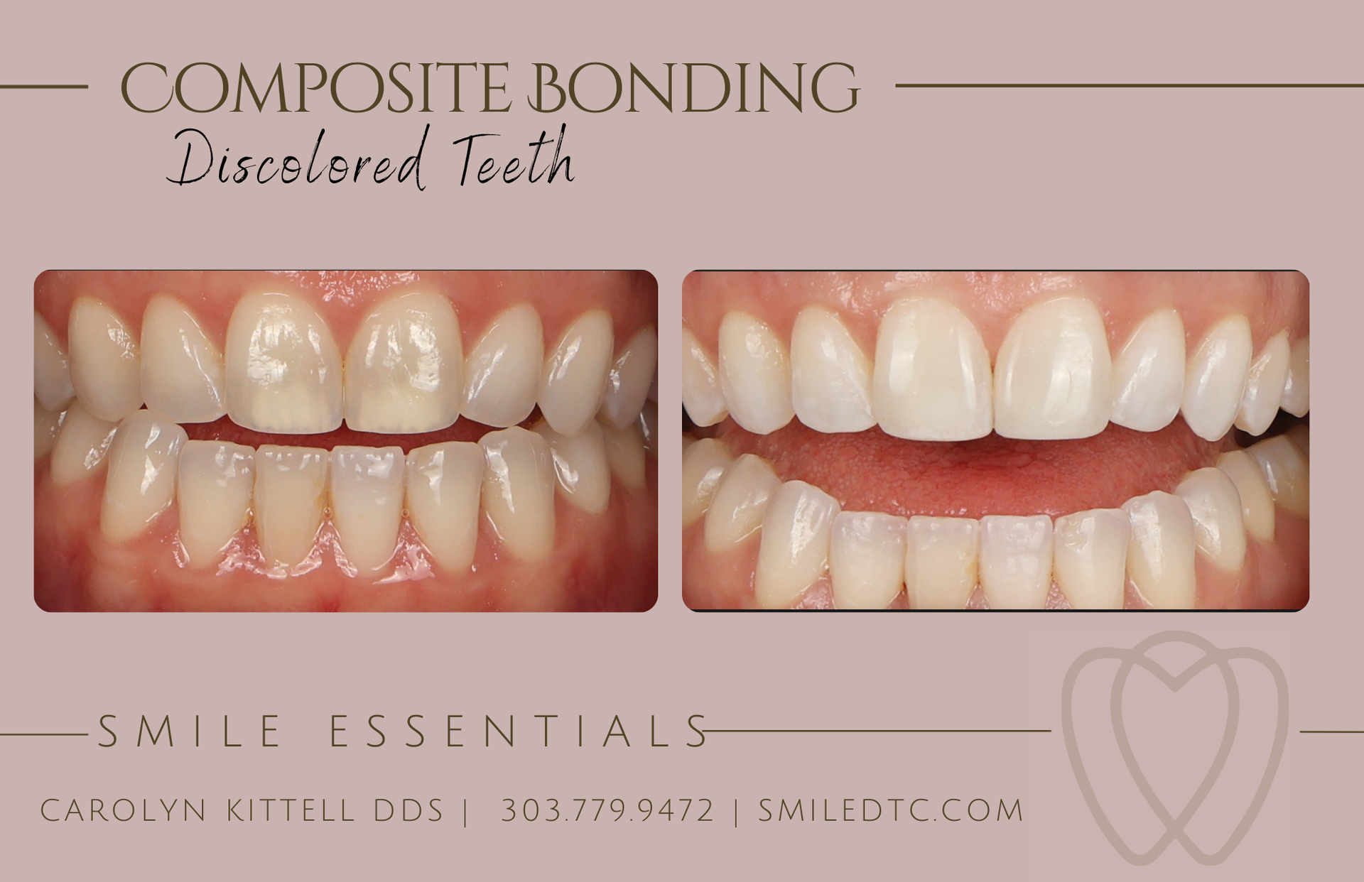 discolored teeth treated with composite bonding for a white straight smile.