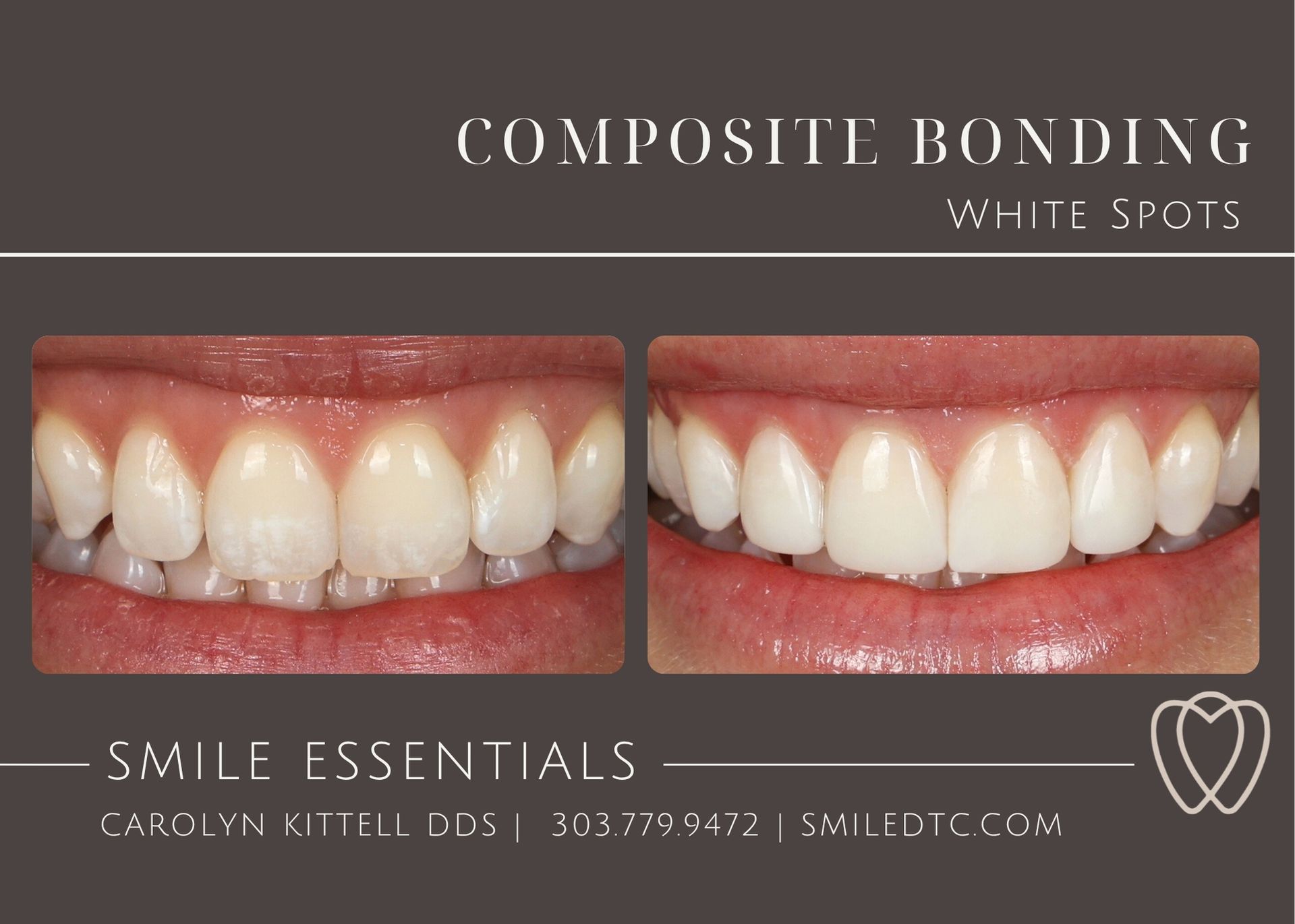 white spots on teeth