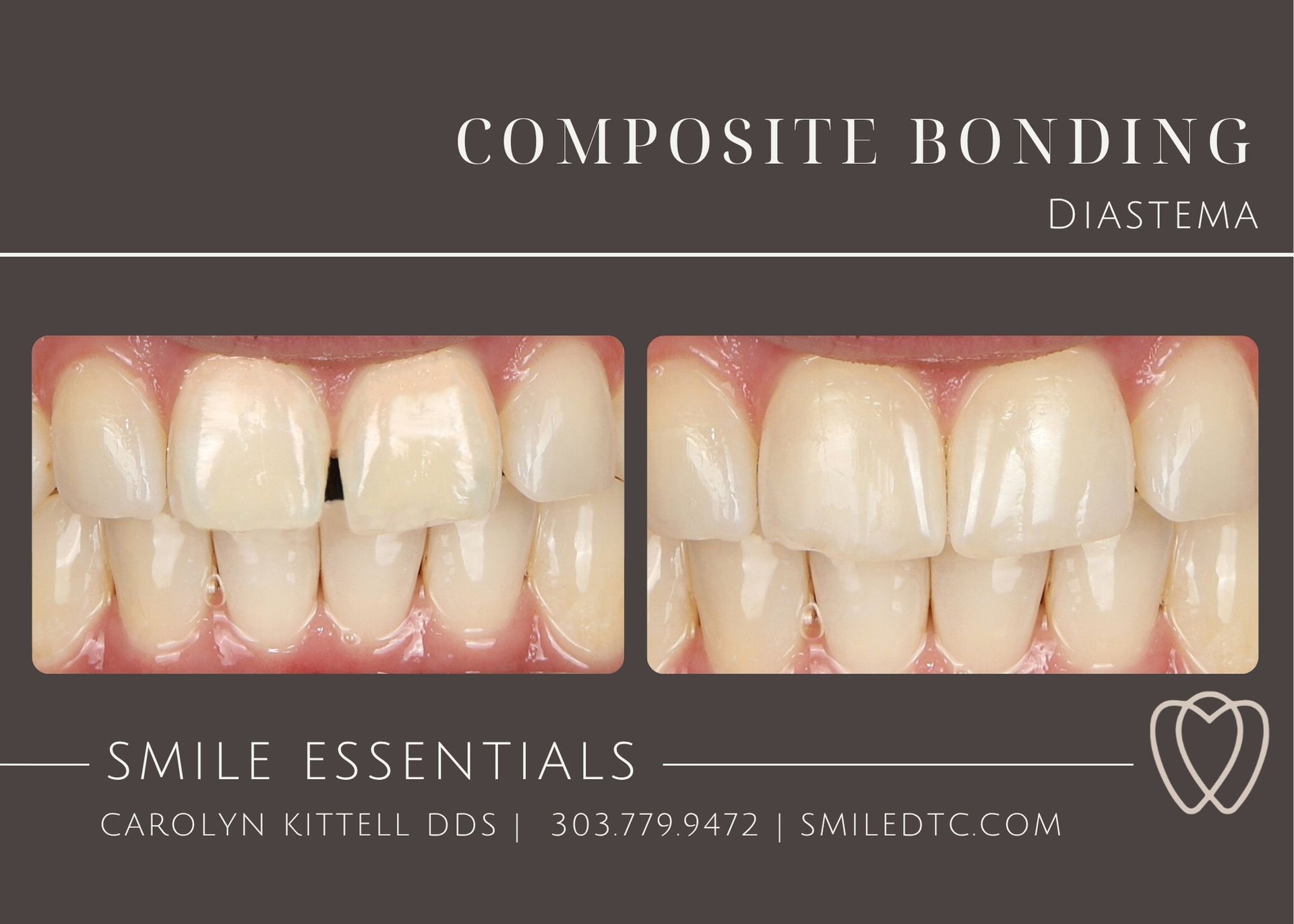 A picture of a woman 's teeth before and after composite bonding