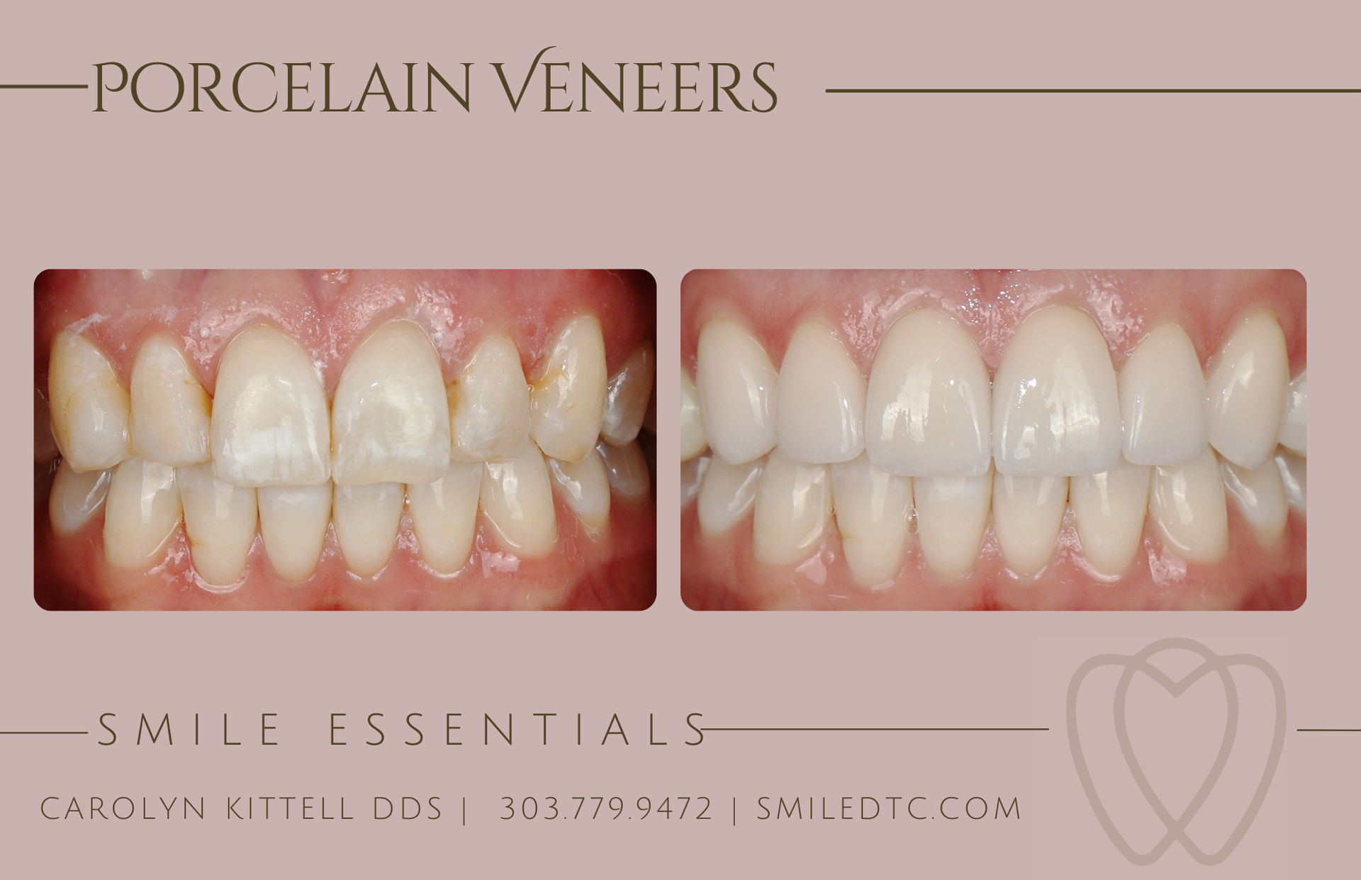 Before and after comparison of teeth  That have white spots. Treated with porcelain veneers; the 