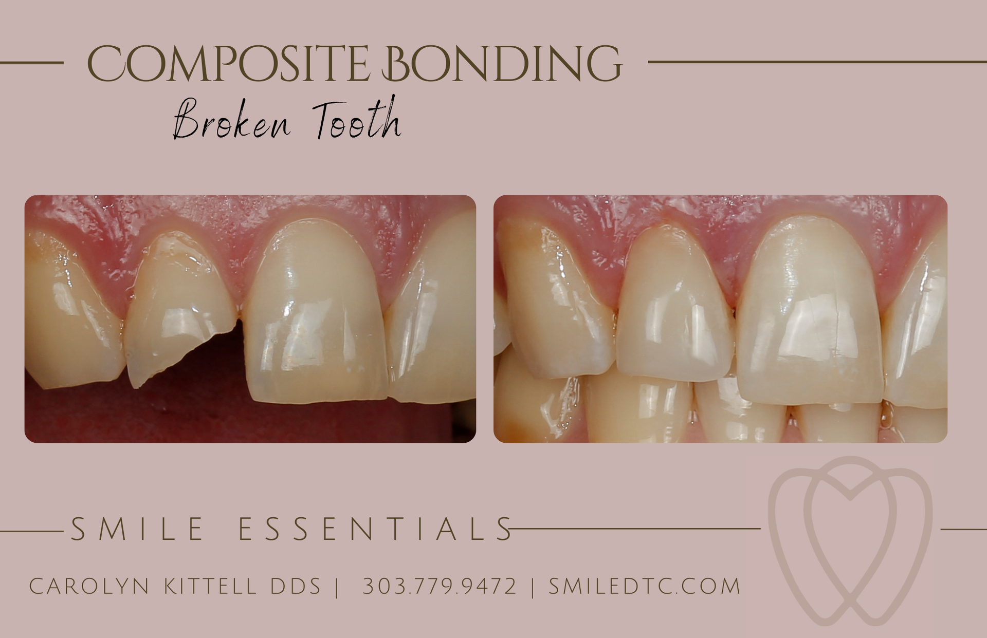 fix a broken front tooth with composite bonding in Greenwood Village