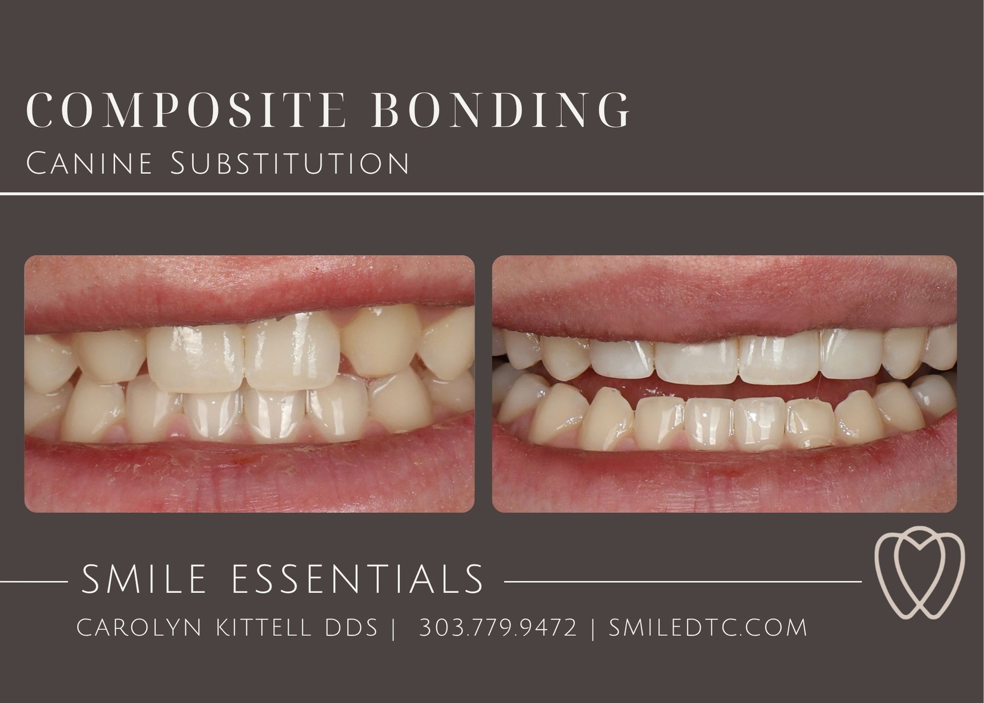 canine subsitution, missing lateral teeth