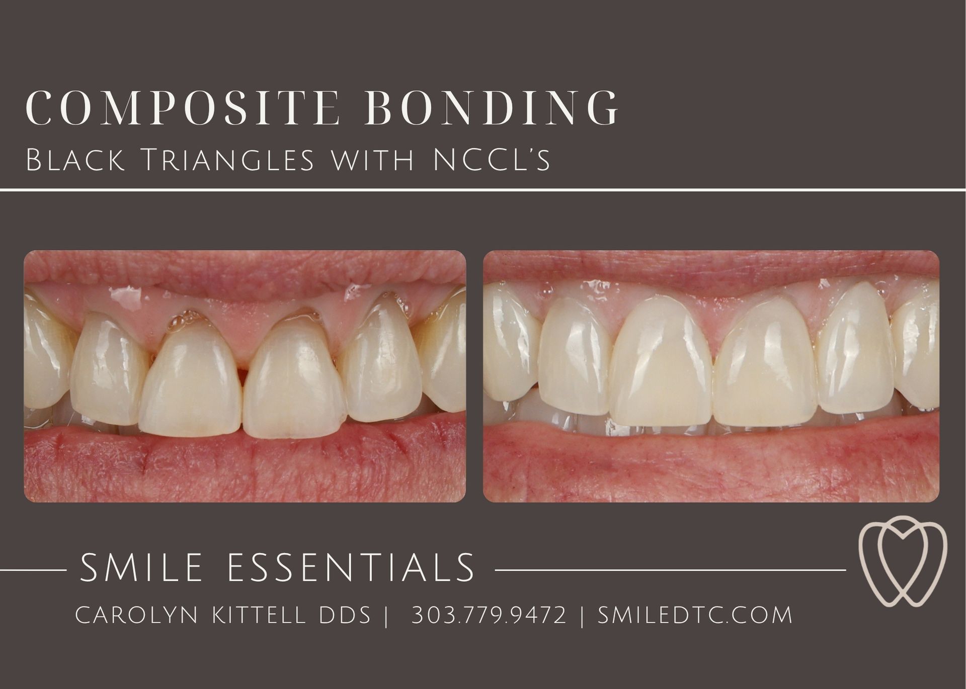 gum recession and bonding