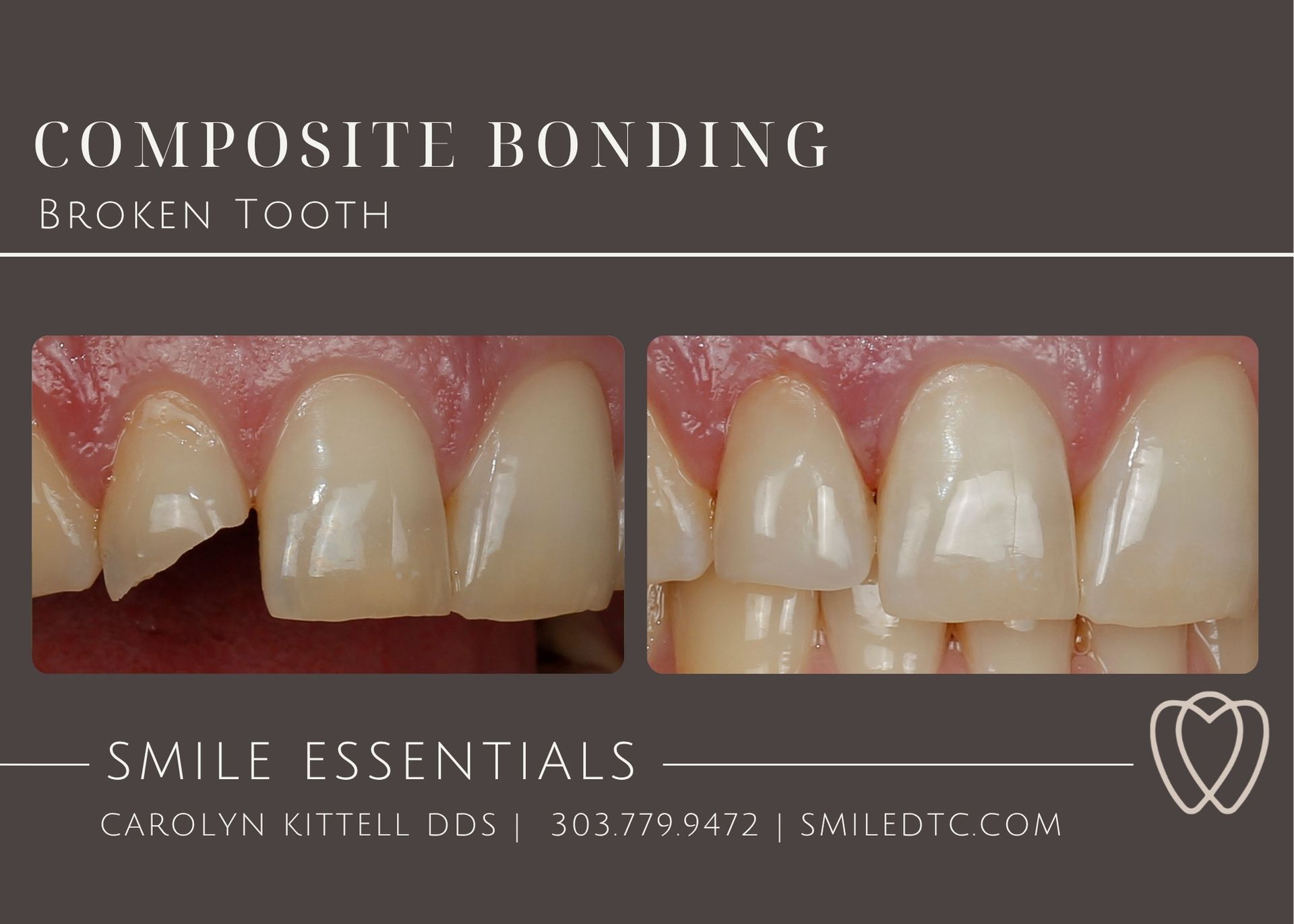 fix a broken front tooth with composite bonding in Greenwood Village