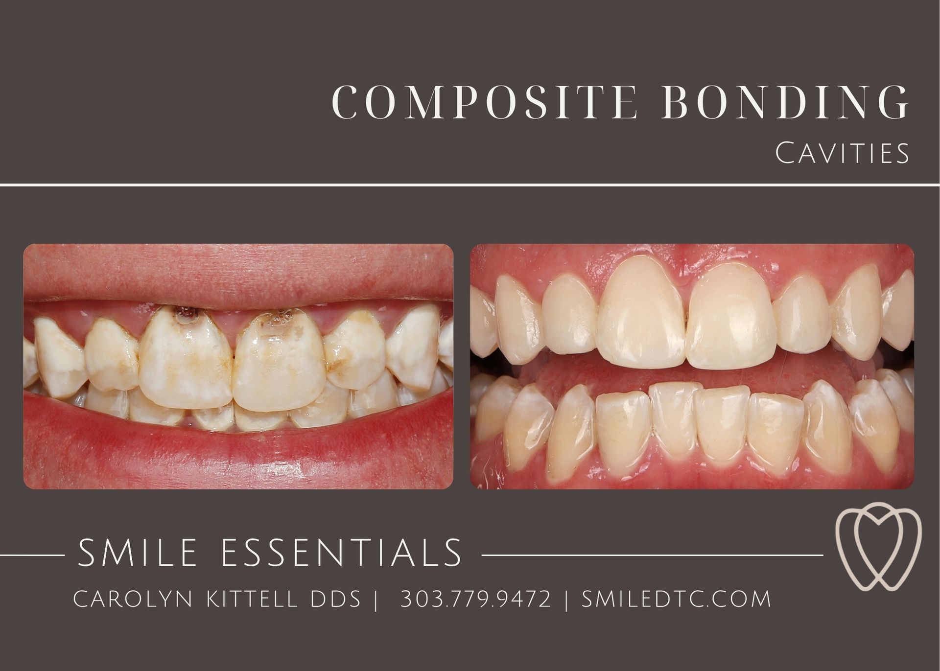 Composite bonding is shown on a pink background