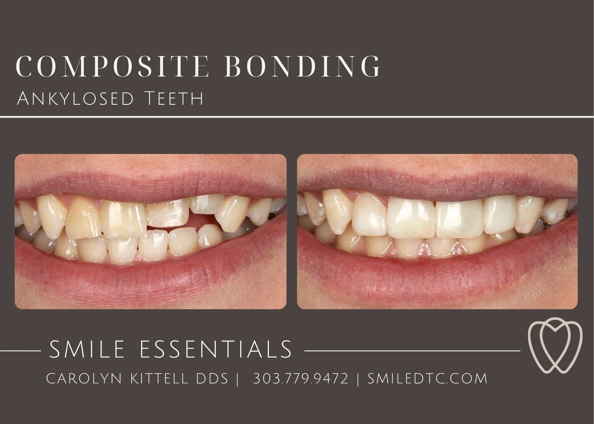 Two pictures of a woman 's teeth before and after composite bonding