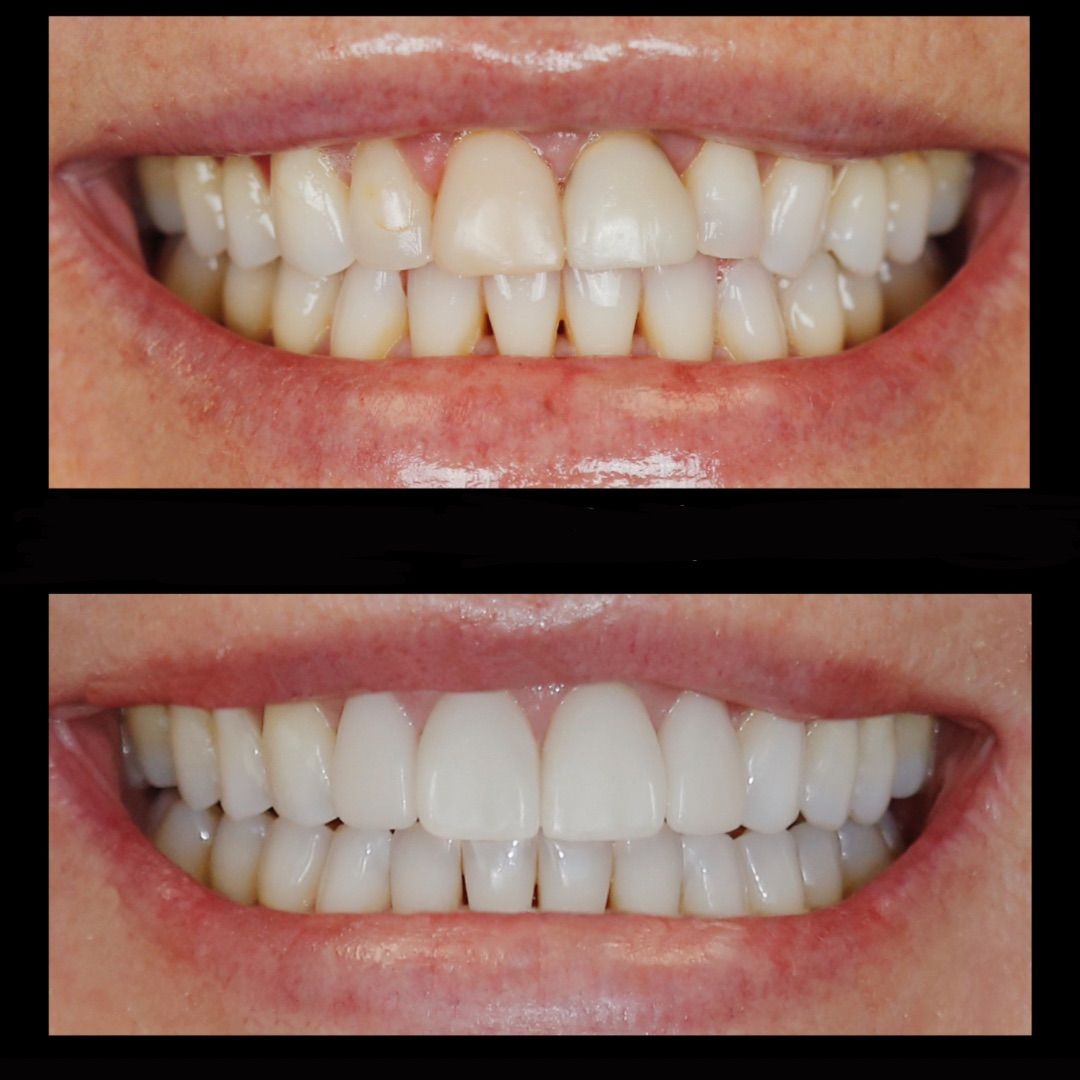 smile makeover in colorado