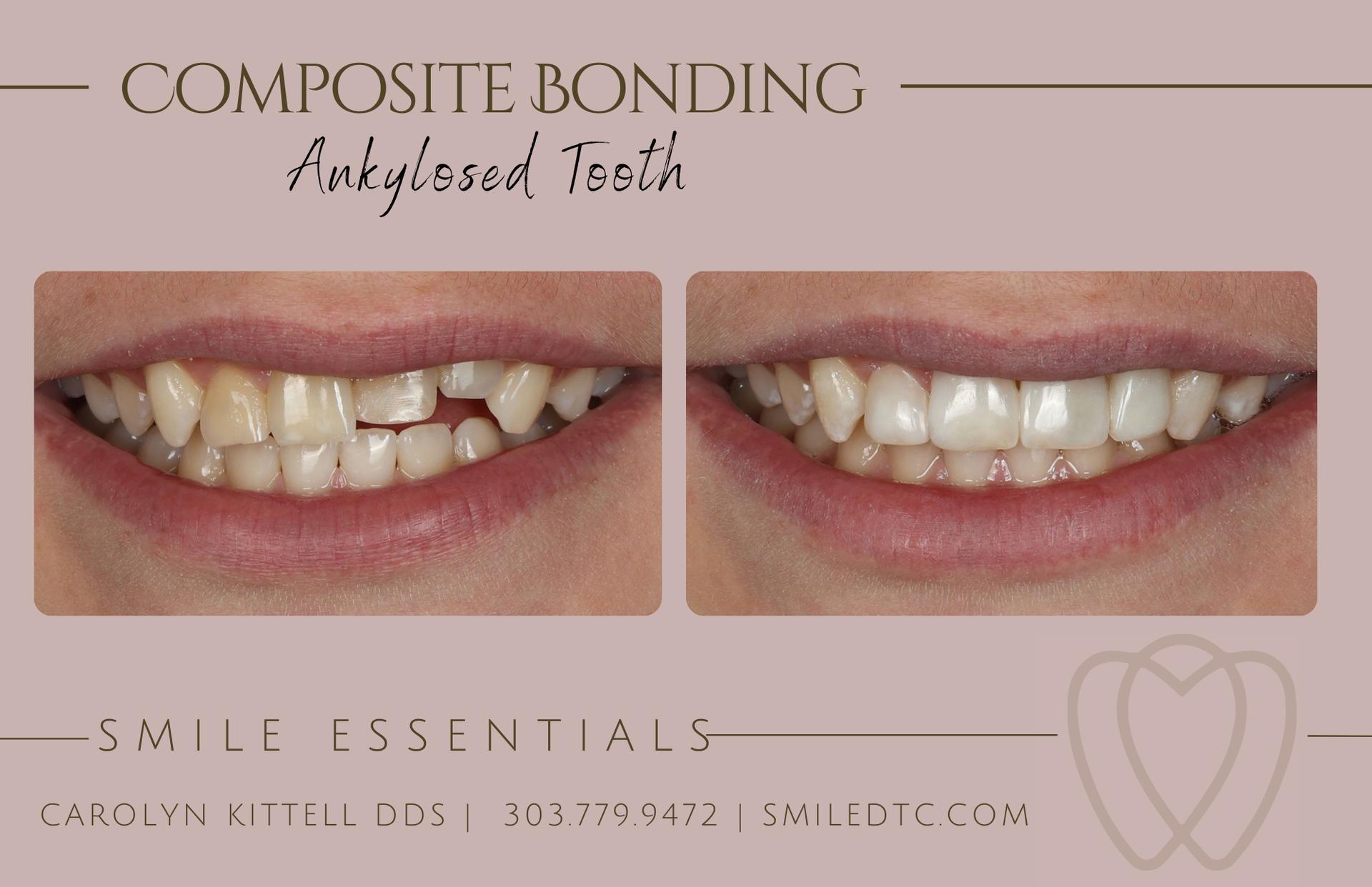 Two pictures of a woman 's teeth before and after composite bonding
