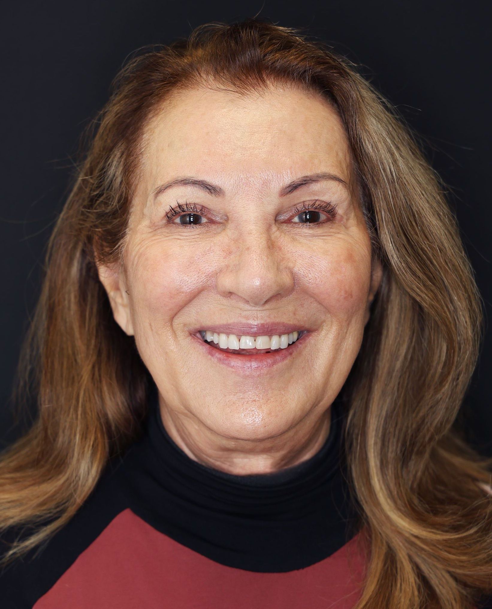 Worn down front teeth with uneven lengths