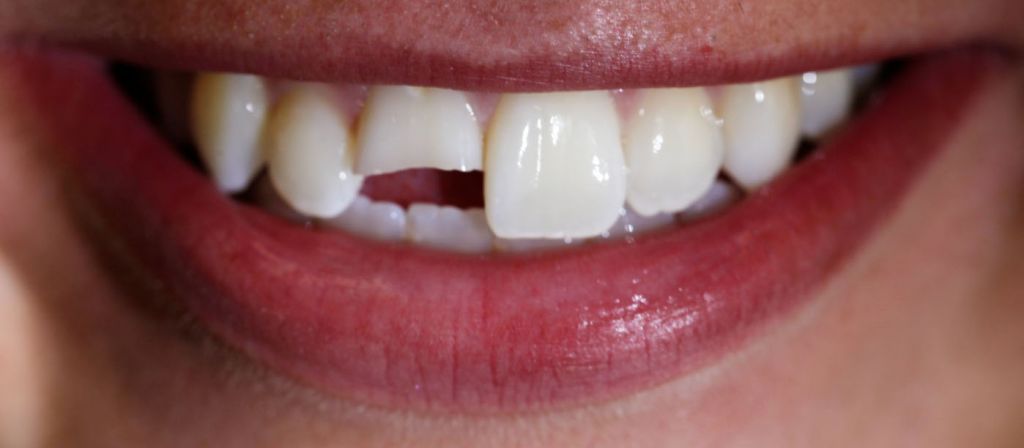 whiten bleach dark tooth smile