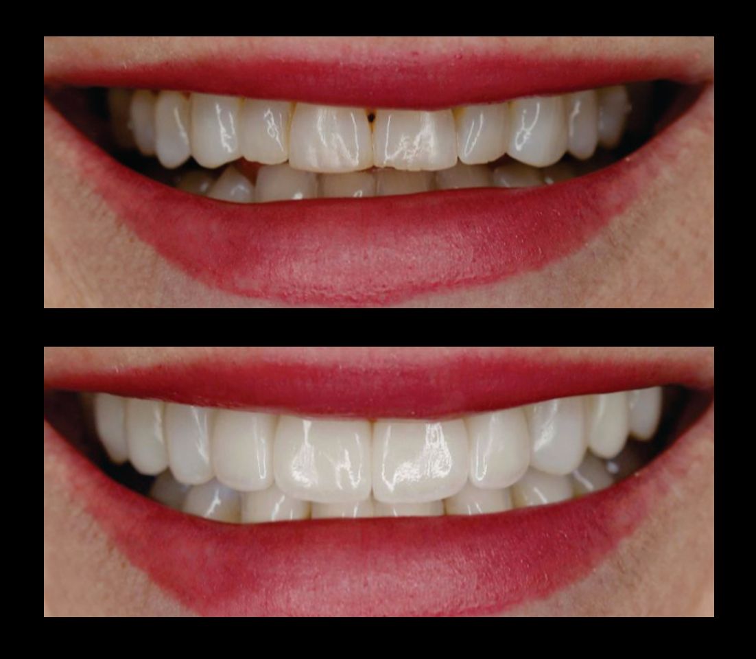 veneers in denver